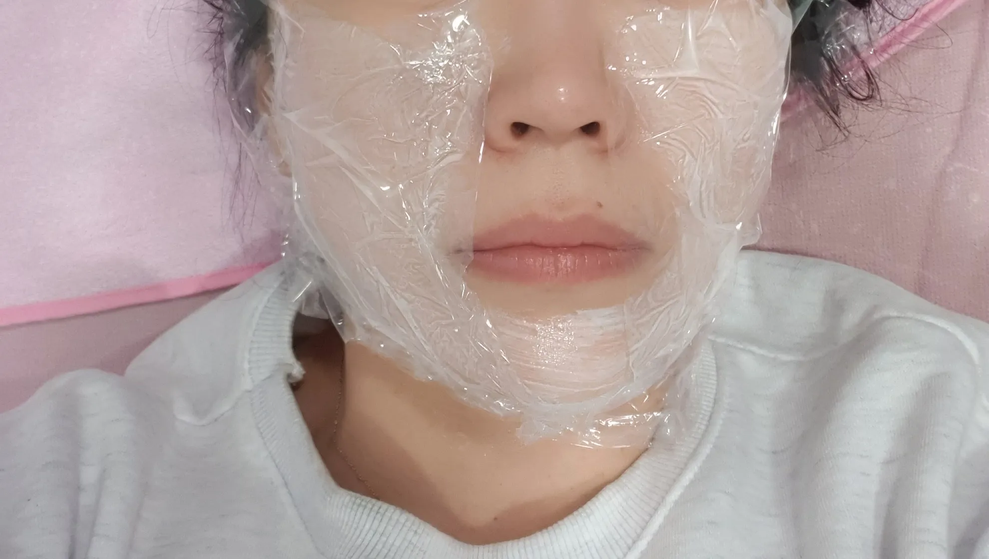 시술 전 — 미케이 피부 탄력개선_슈링크 300샷