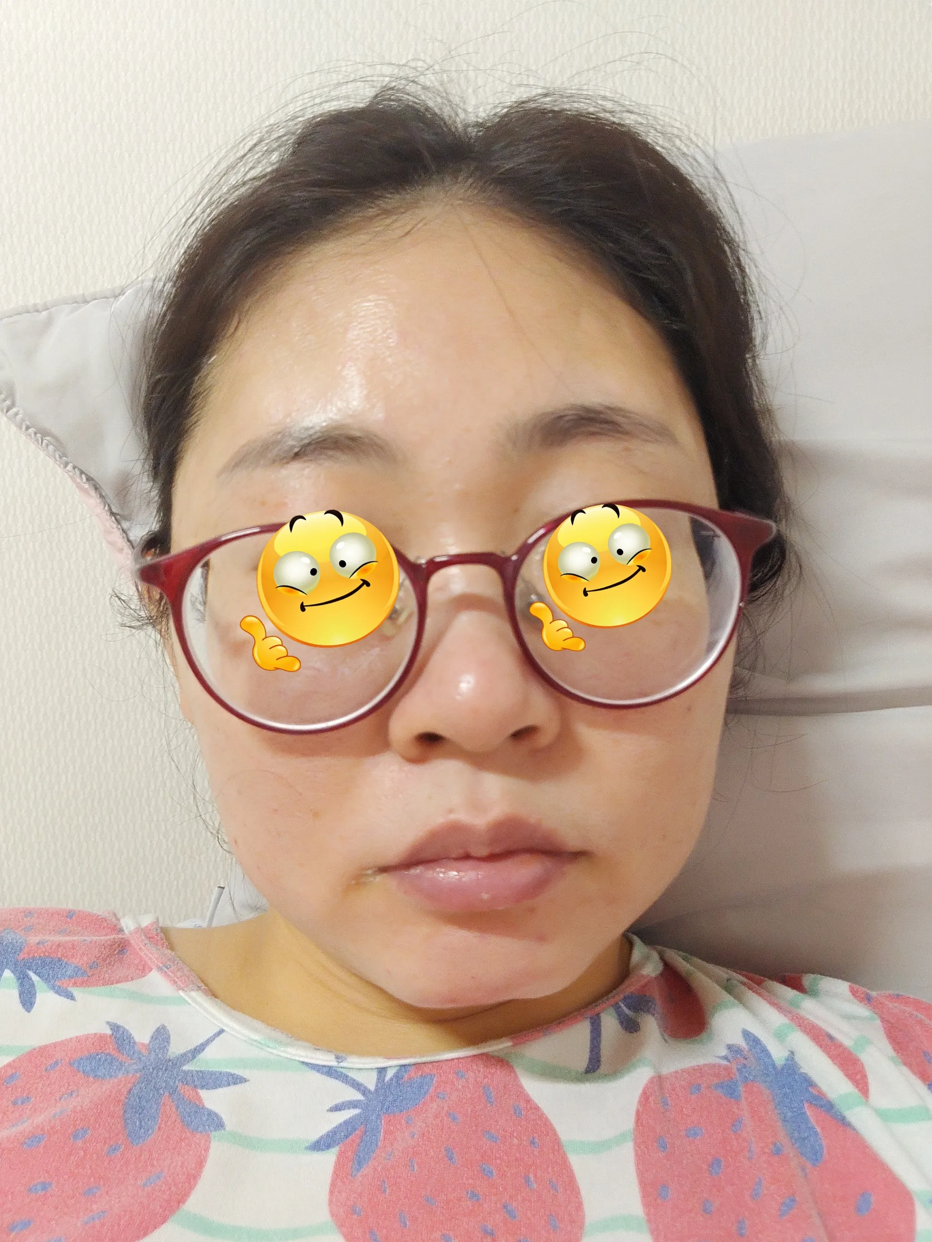 After treatment — ★ Rejuran Healer 7.9 ★ Pore Reduction, Skin