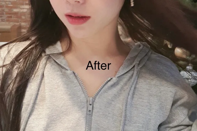 시술 후 사진