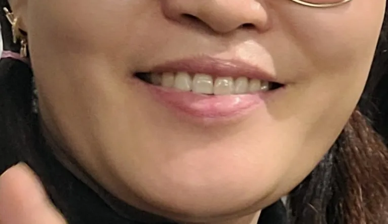 시술 후 사진