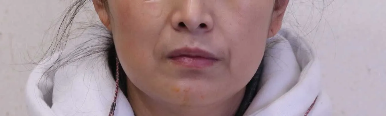 시술 전 — 팔자주름 생생필러