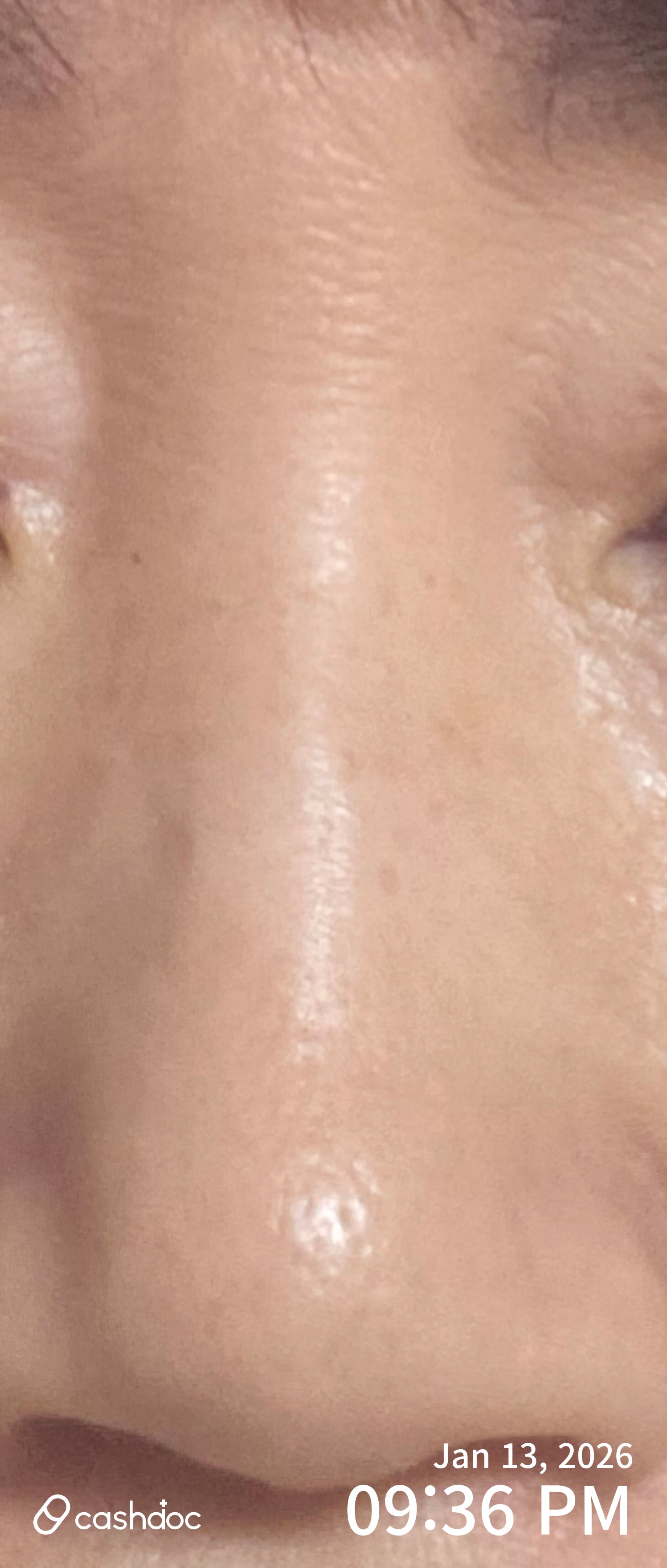 서초구 벨뷰의원에서 성공적인 보톡스 경험!