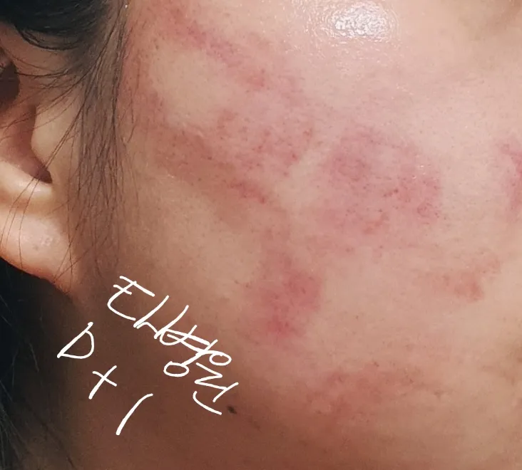 시술 전 — 인모드리프팅 지방컷 V라인
