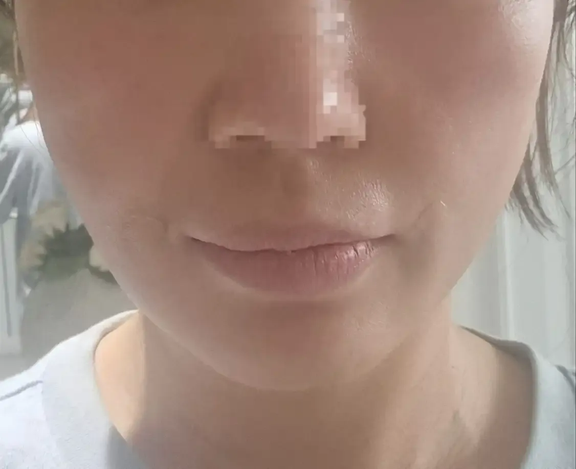 术后照片