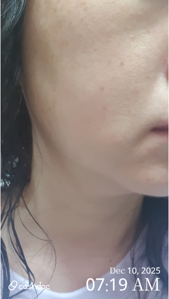 강남구 이호표피부과의원, 기미 잡티 레이저토닝 후기