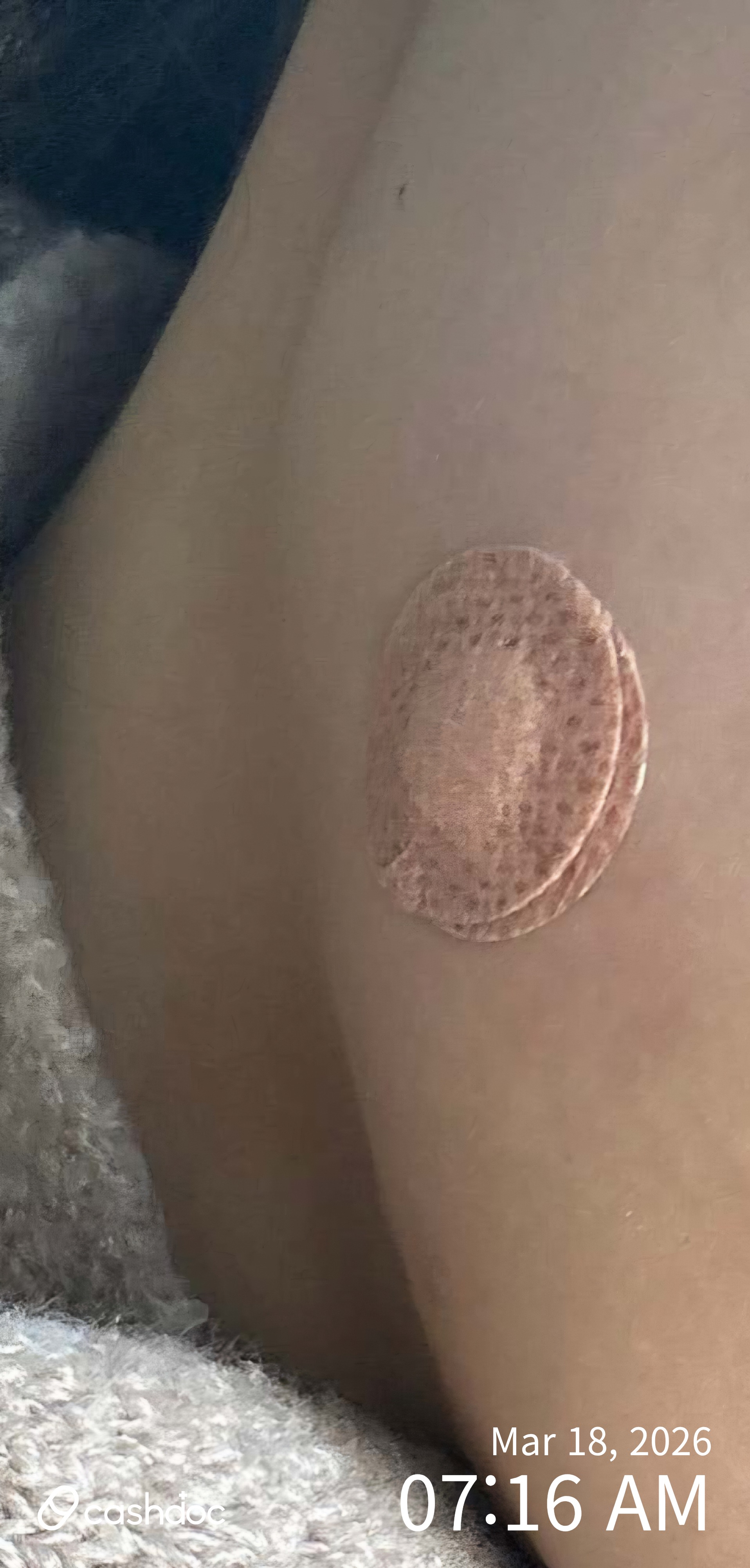 제주시 배진성마취통증의학과의원, 표피낭종 주사 치료 후기