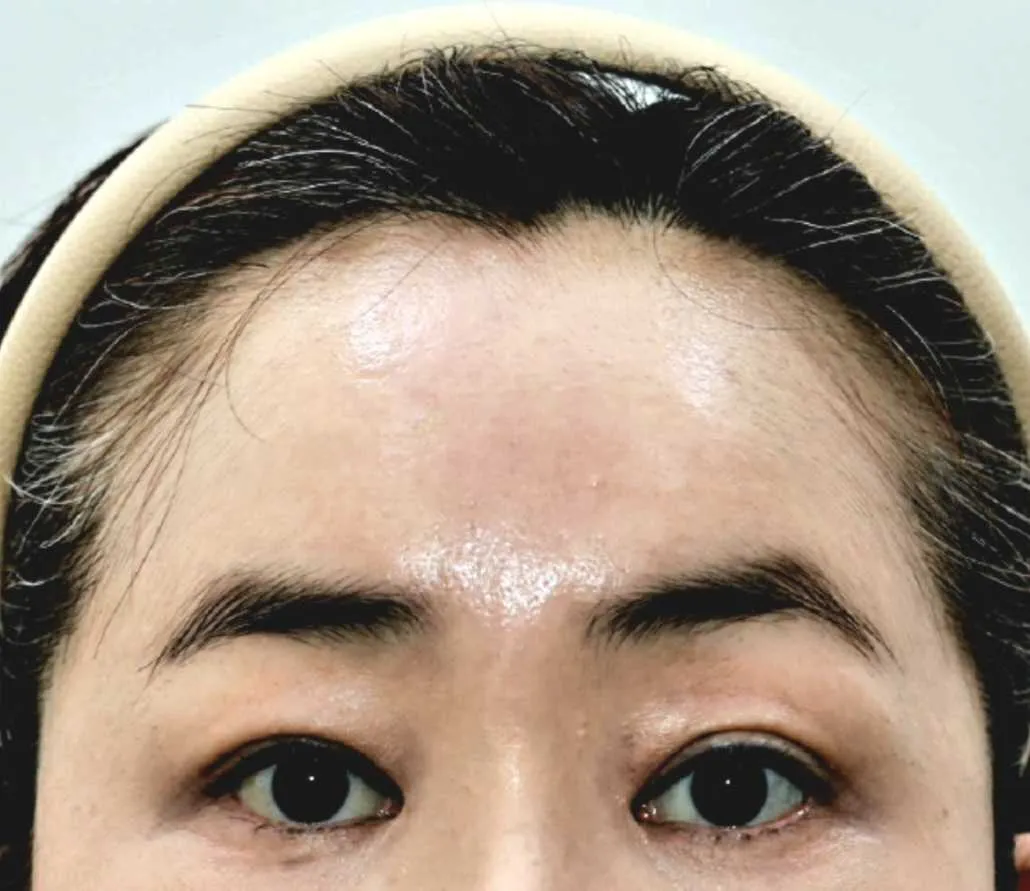 시술 후 — 3,5,7 펌라인자연유착