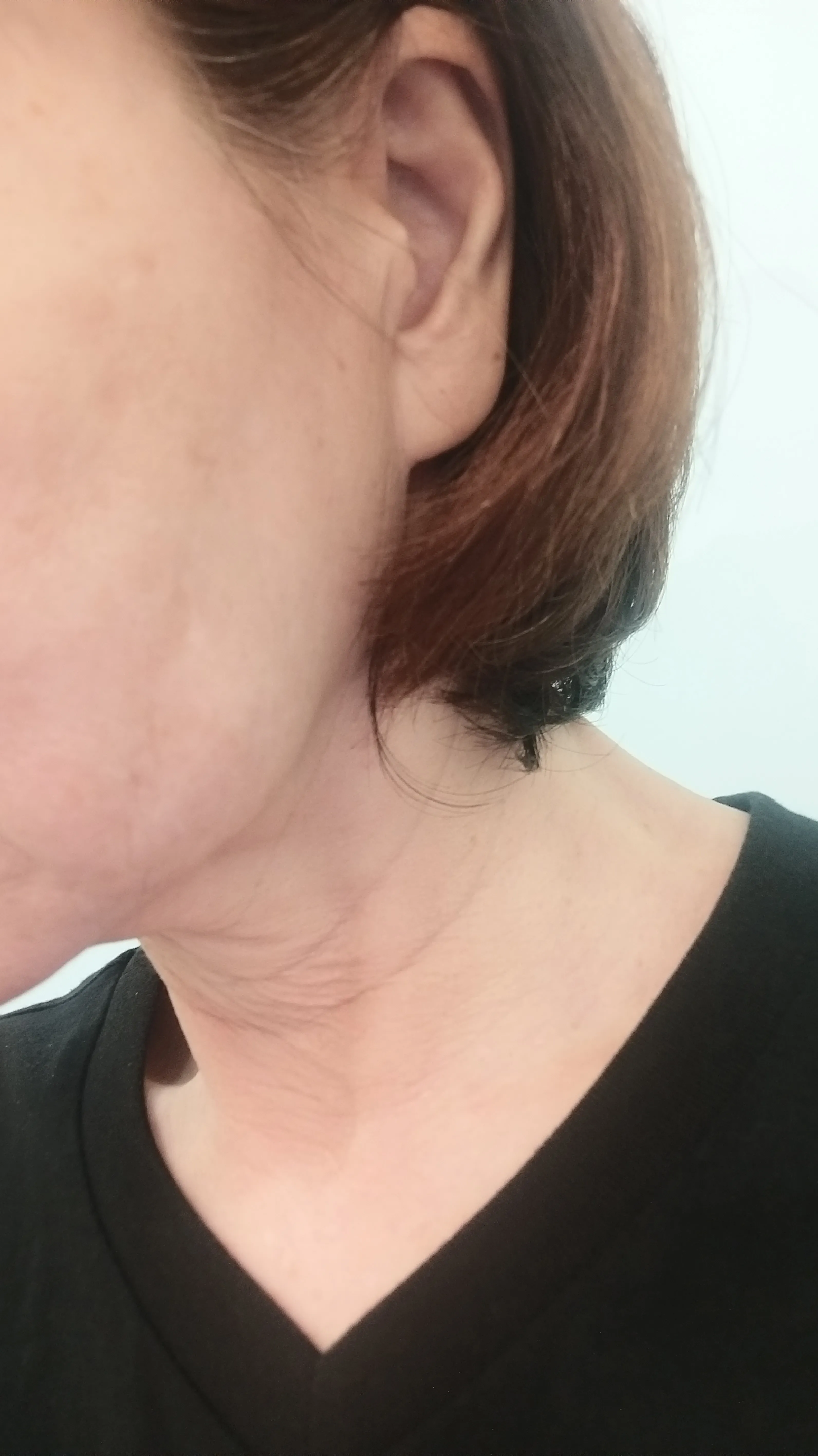 After treatment — Skin Regeneration #Skin Elasticity #For Fine Lines: Rejuran Healer
