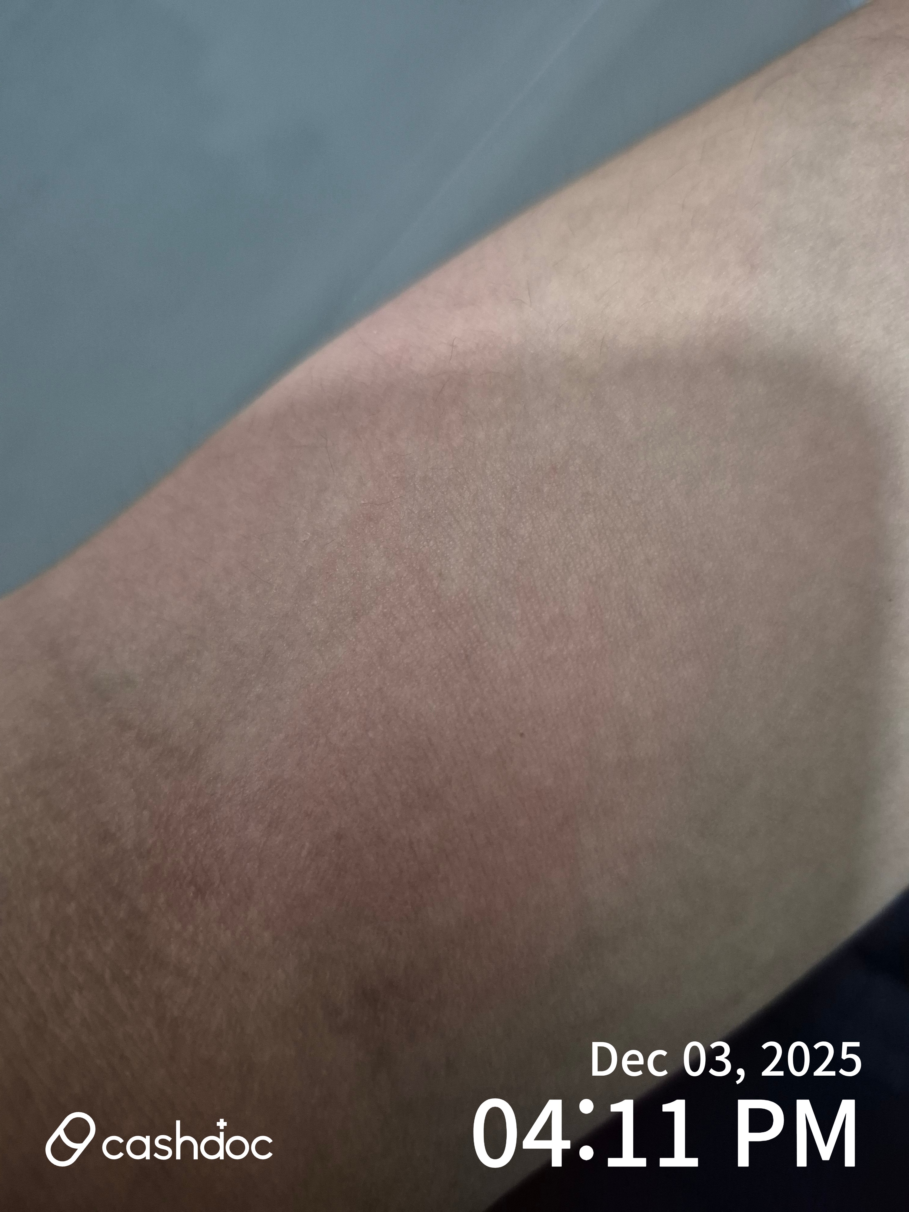 위드피부과의원에서 아토피 광선치료 후기 - 점진적 호전 감사합니다