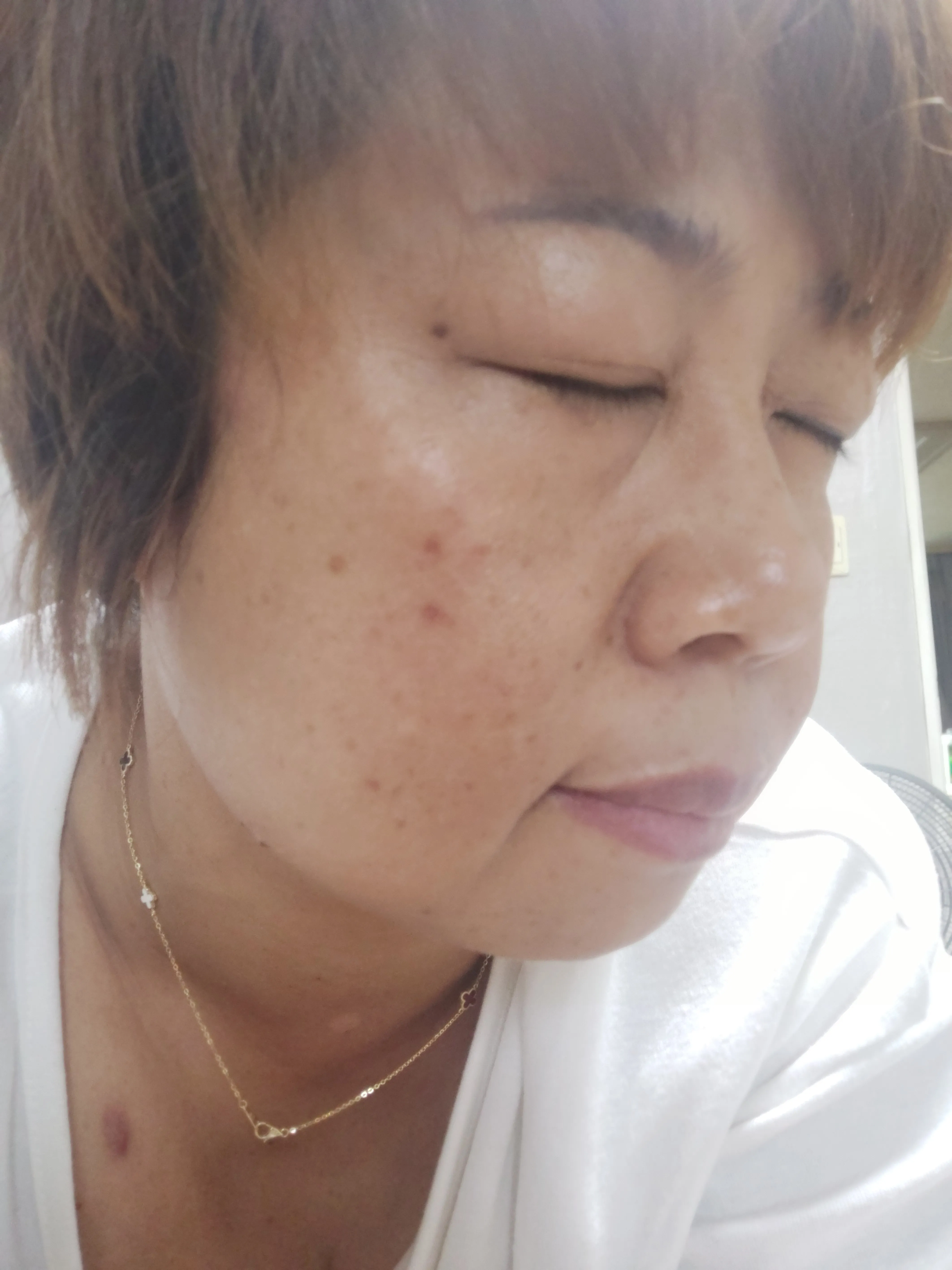 시술 후 — 기미/색소 완벽파괴! #대세 피코토닝