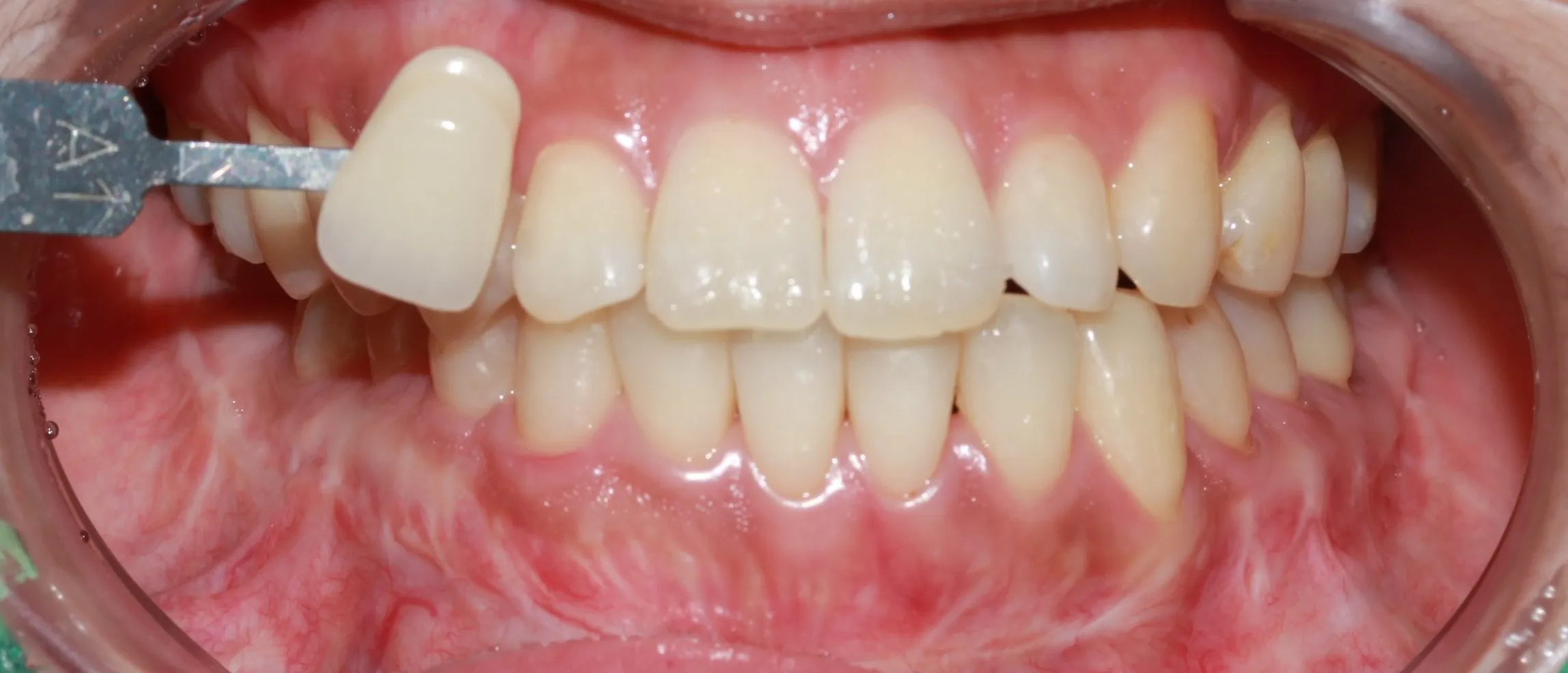 Before treatment — 30-Minute Complete Teeth Whitening Program