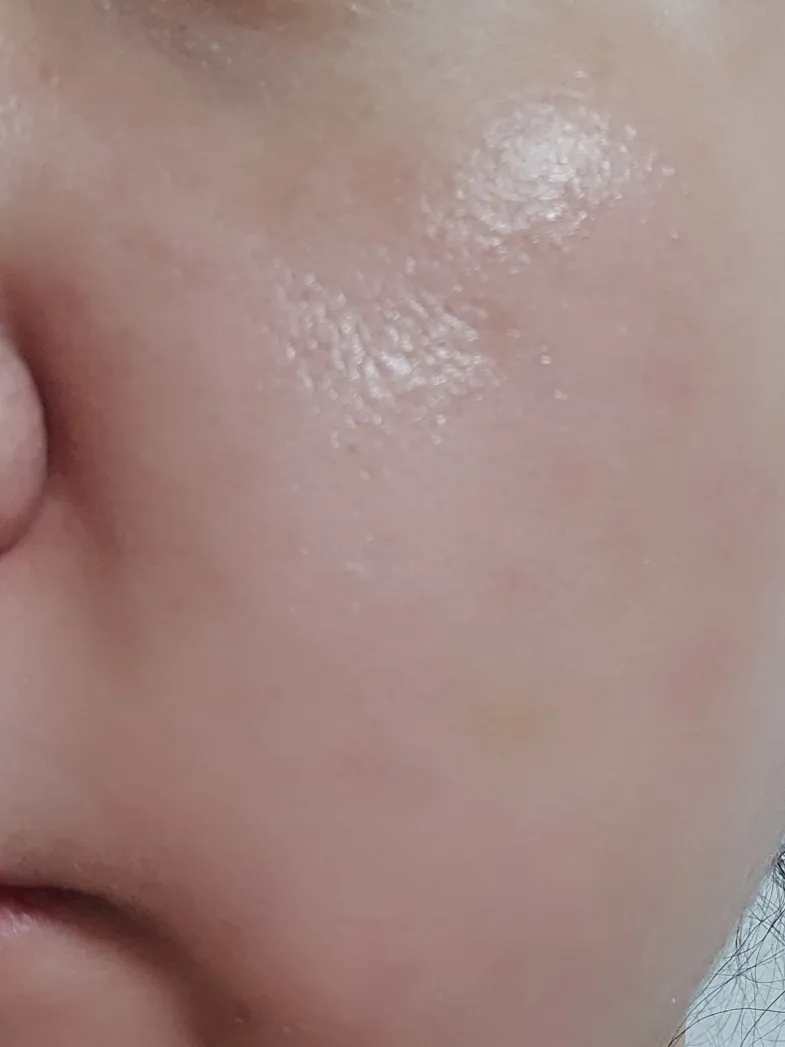시술 후 — 명품스킨부스터 #NCTF주사 