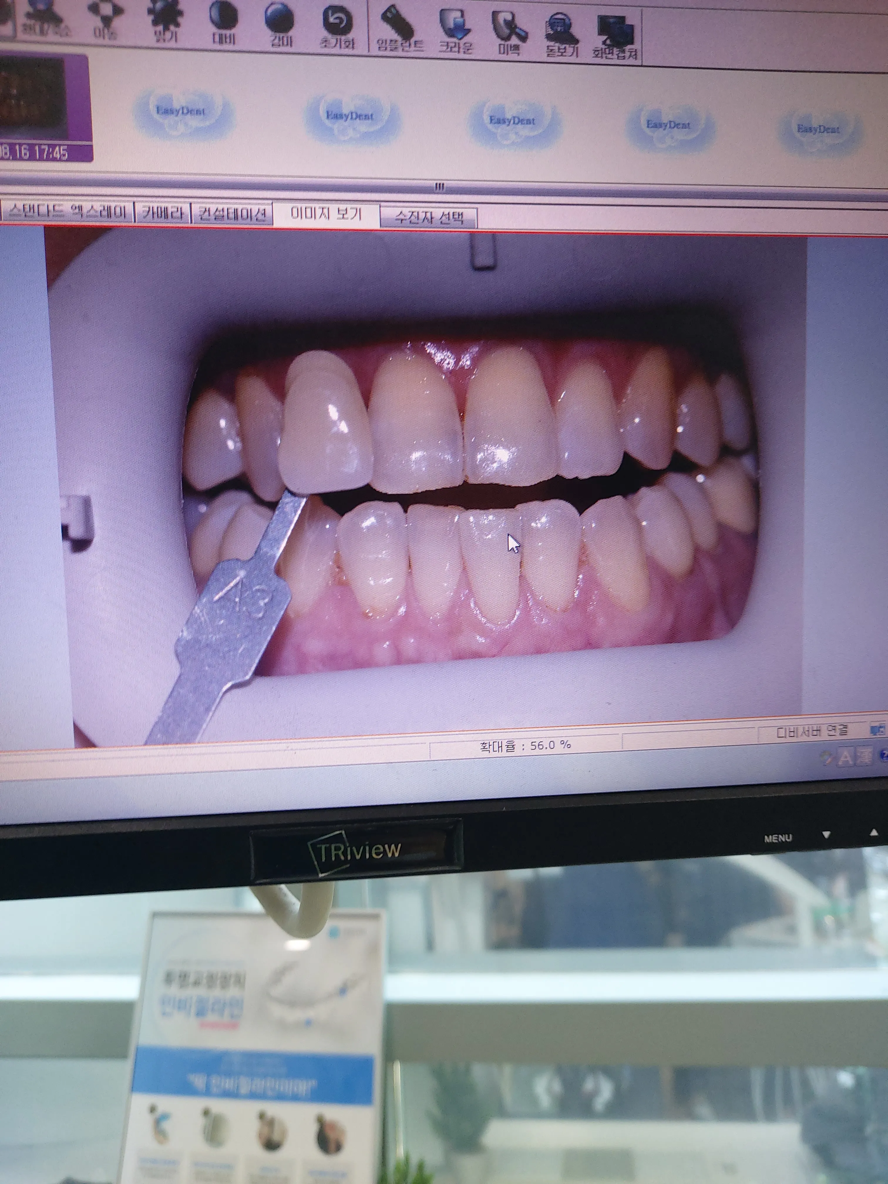 After treatment — Teeth whitening, really! ♥ 39,000 won ♥