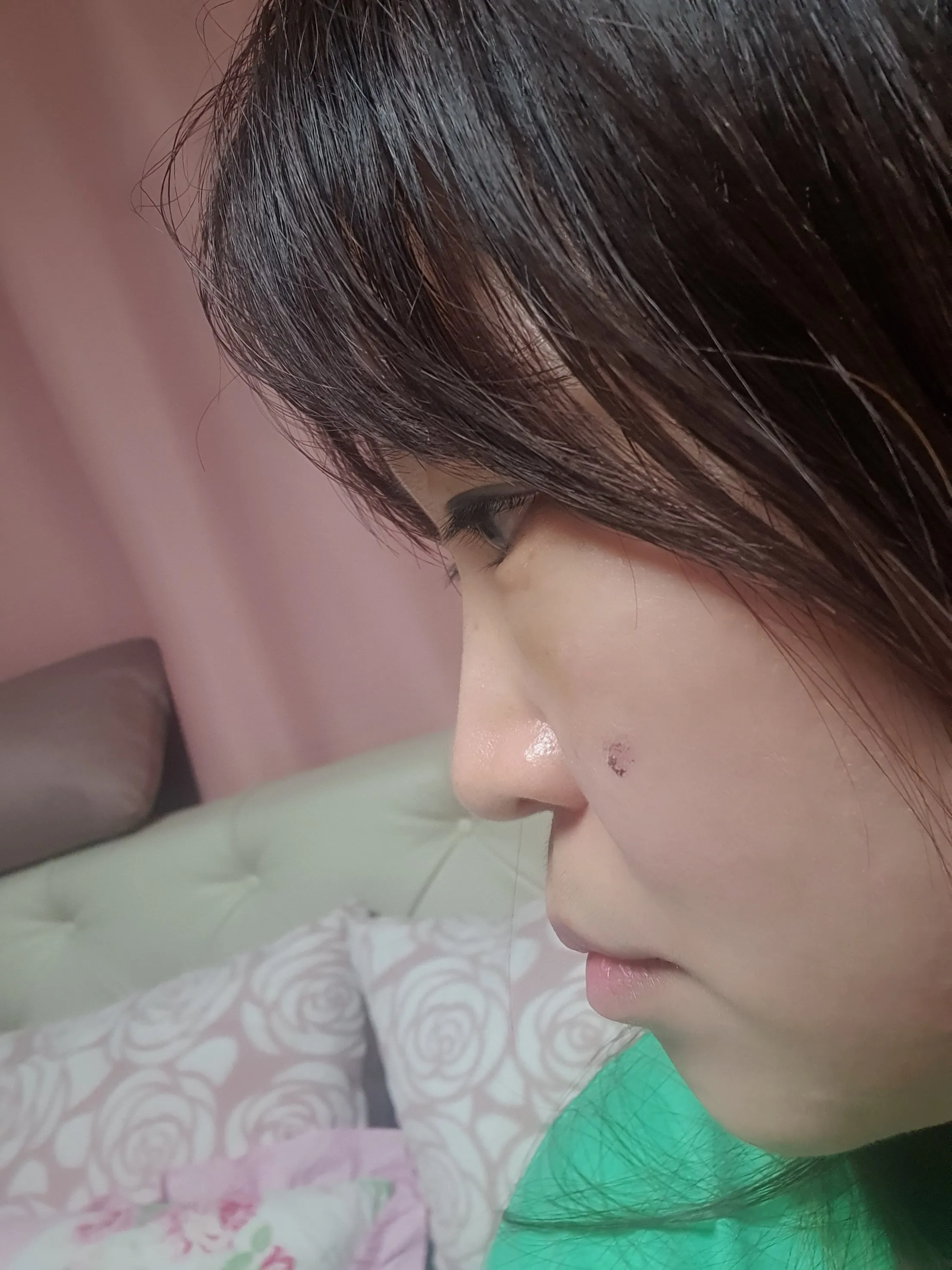 시술 전 — 피코토닝