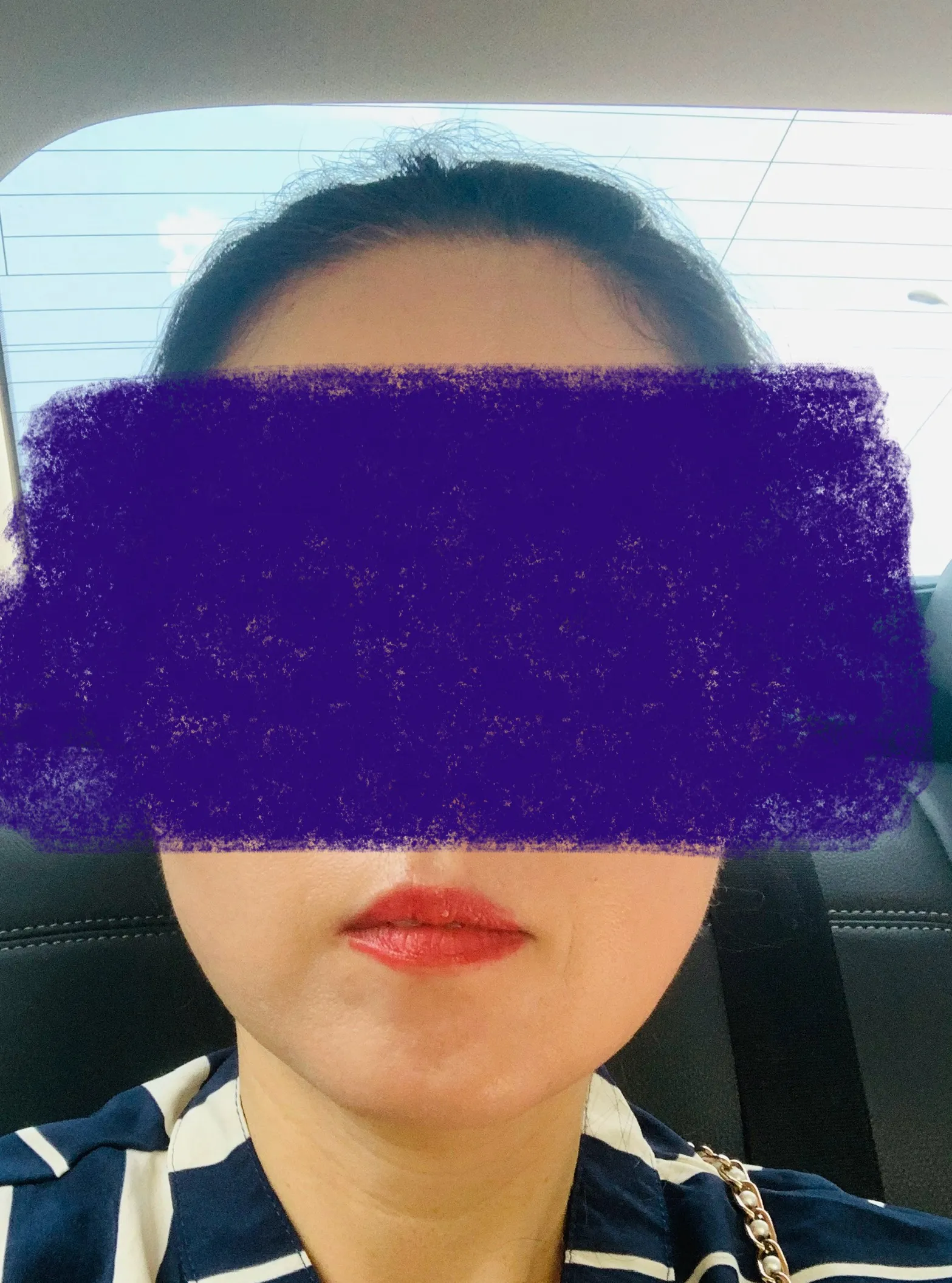 시술 전 — 미케이 민트실 동안 리프팅_팔자,눈가