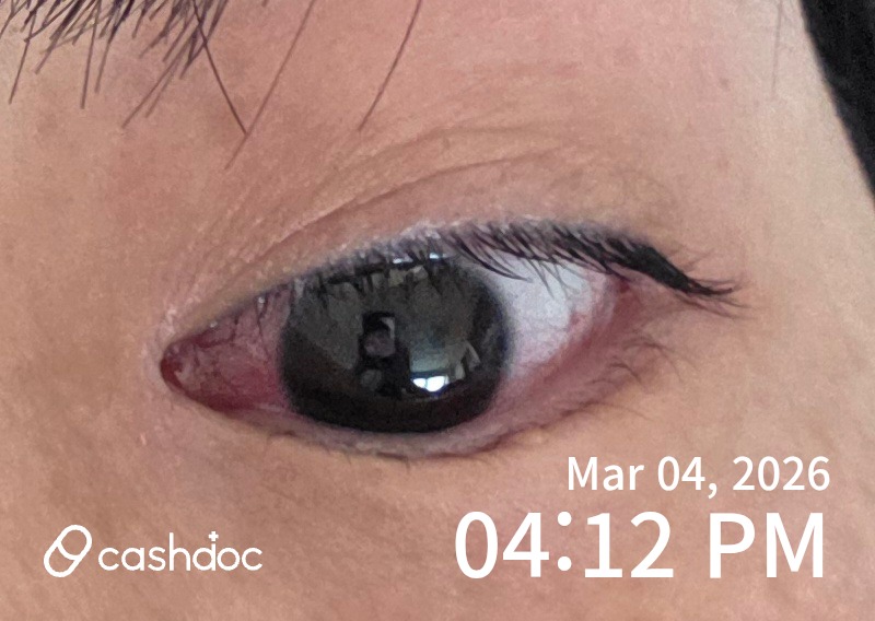 미추홀구 리더스윤안과의원에서 눈 통증 해결 경험