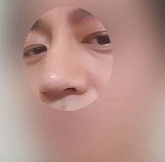 시술 전 — 잘생김에 기준! 남자 코성형