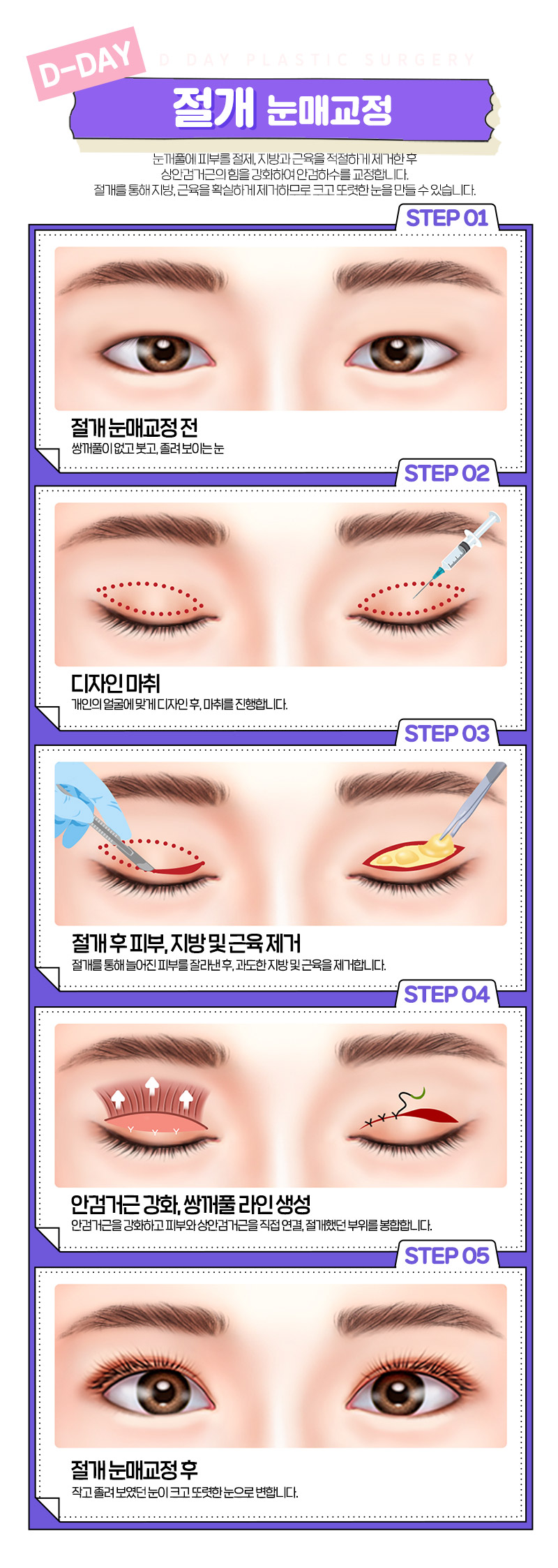 디데이성형외과의원 디데이💖비절개눈매교정 이벤트, 시술 상세 이미지