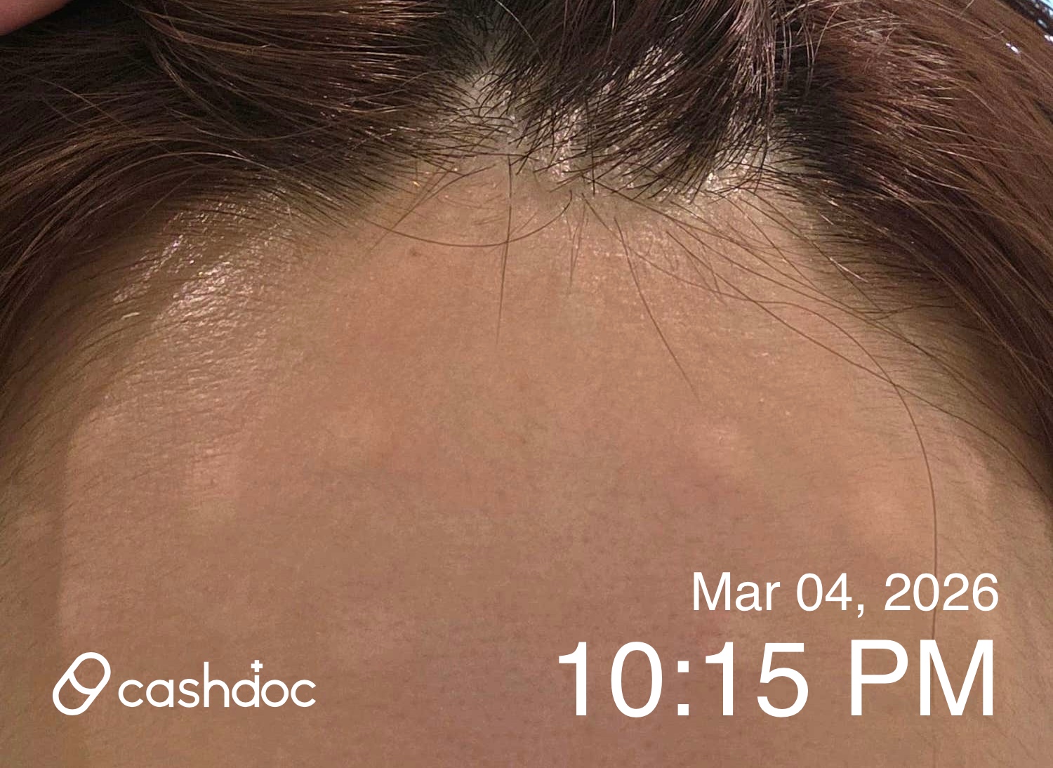 노원구 초이스피부과에서 이마 보톡스로 주름 개선 성공!