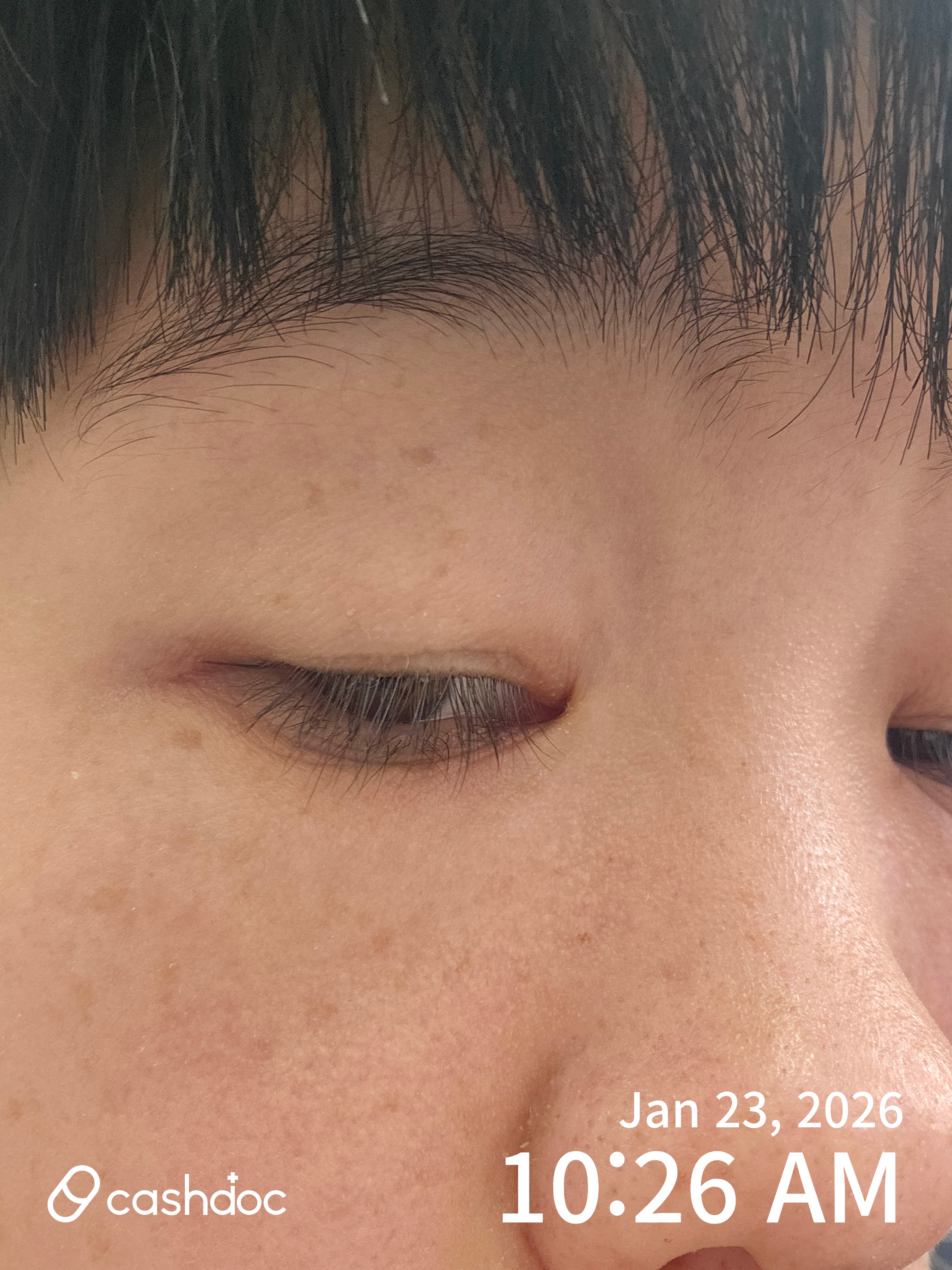 영월군 밝은김안과의원에서 눈썹 연고로 통증 해결!