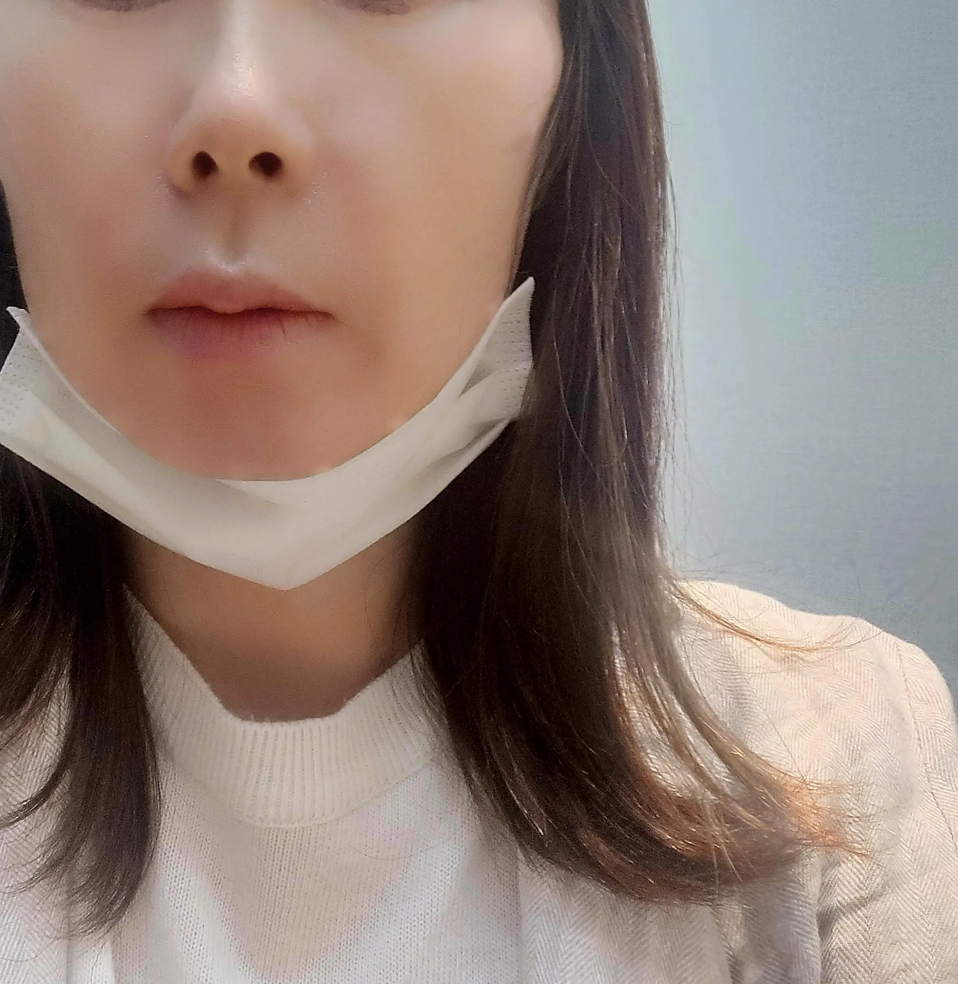시술 전 — 프라이드 이마필러 & 팔자필러