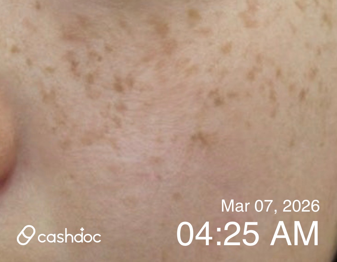 동작구 연세큐원피부과에서 레이저 시술 경험, 만족스러워요!