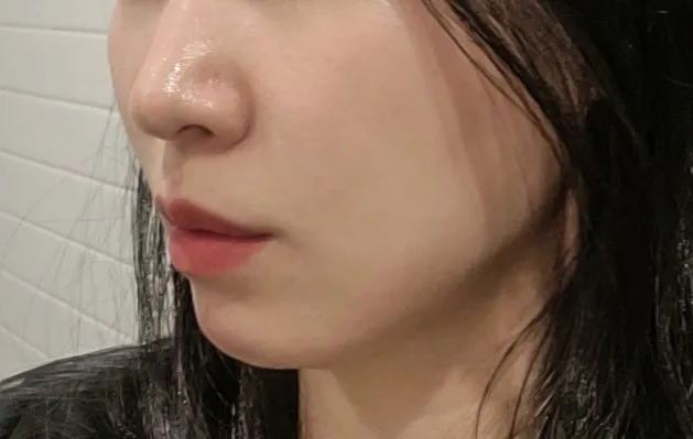 시술 후 사진