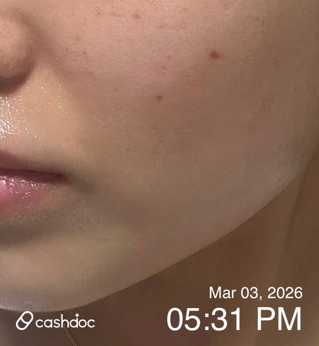 서초구 핸슨의원에서 기미 잡티 제거 후기!