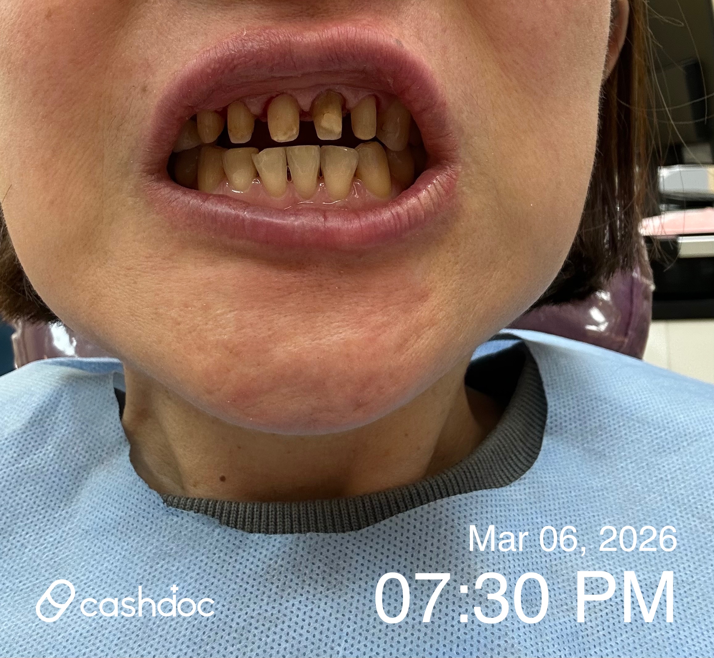 아산시 본치과의원에서 앞니 보철 완벽하게 교체해요