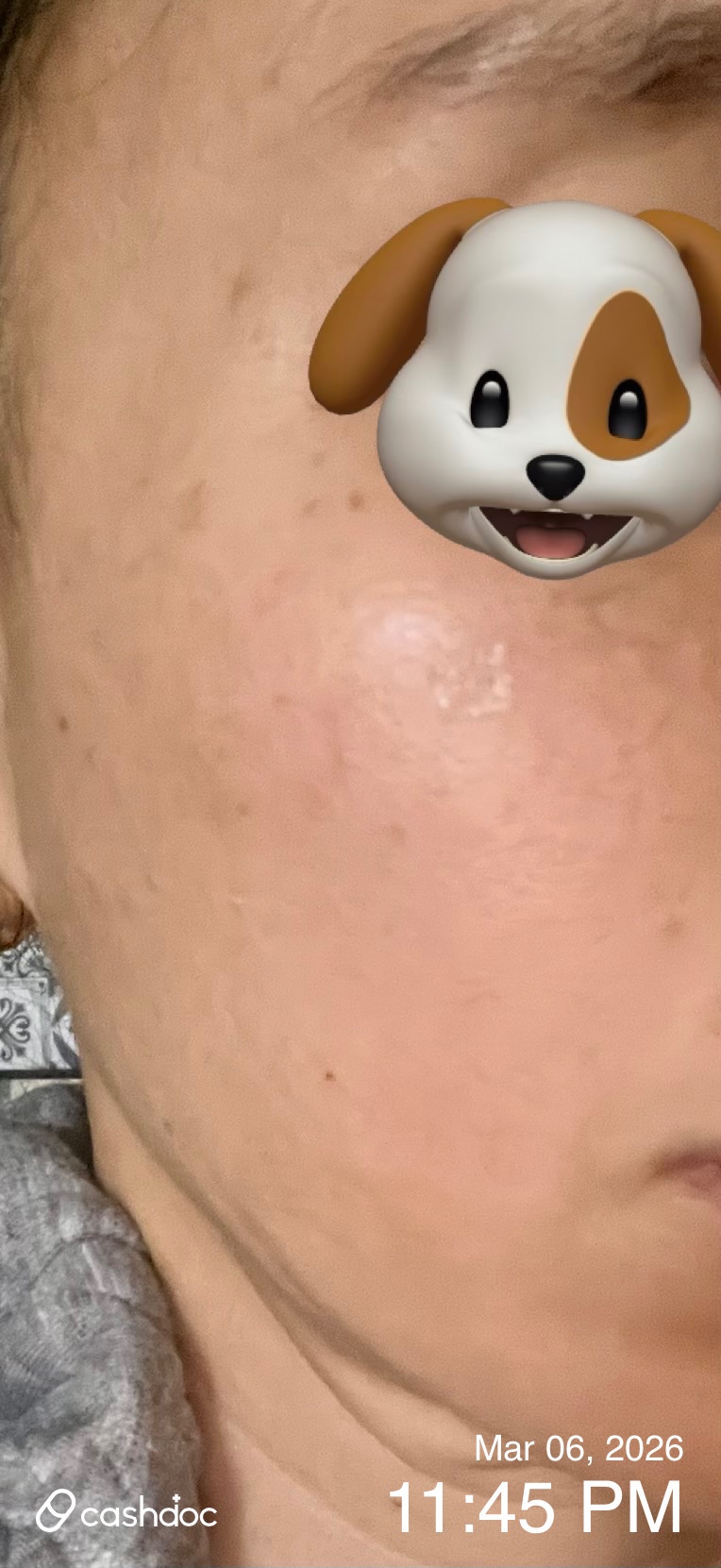 미추홀구 메이퓨어 인하대역점, 볼필러 시술 후 완전 만족!