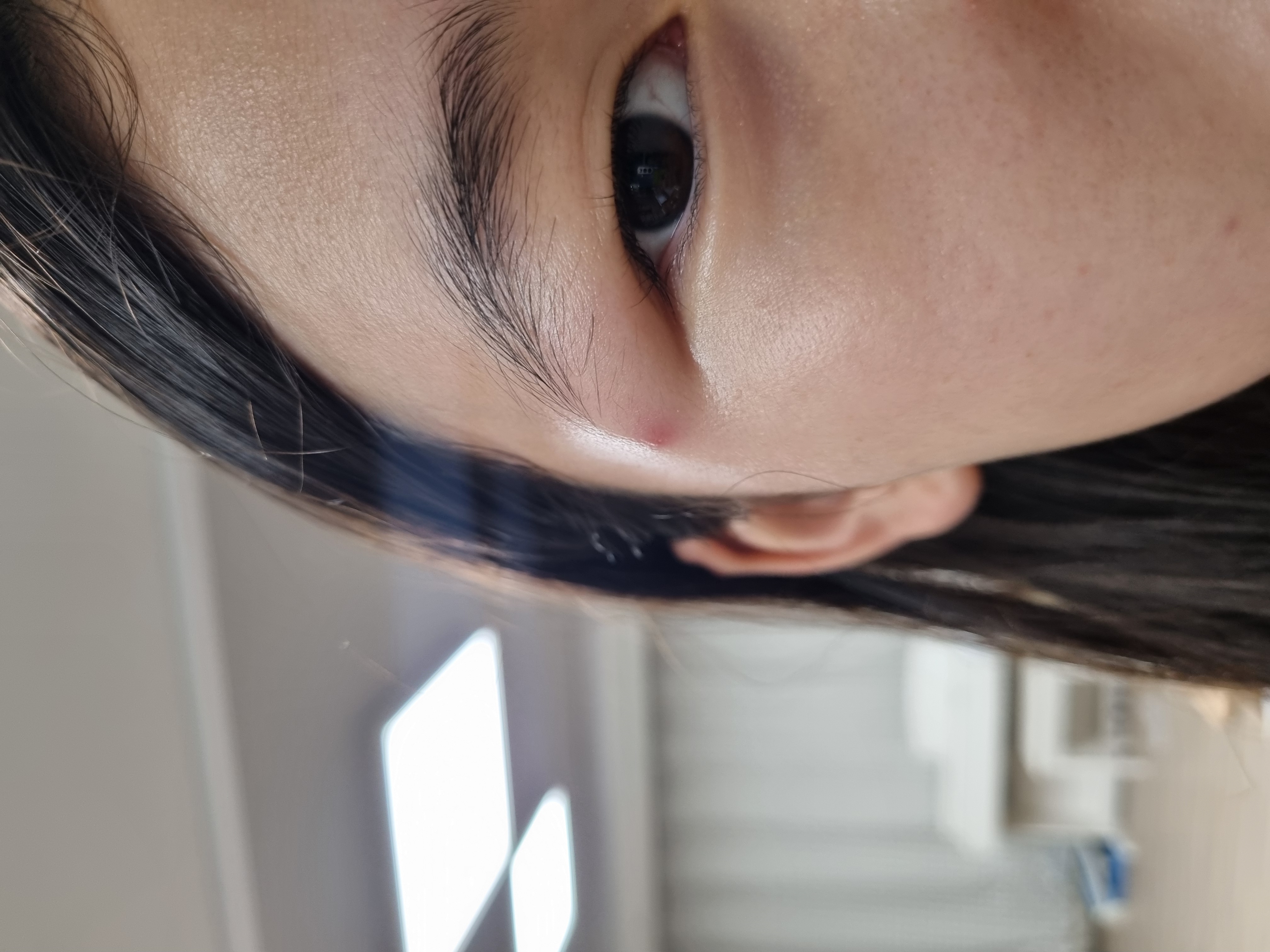 파주시 손호찬피부과의원, 아이 사마귀 치료 후기