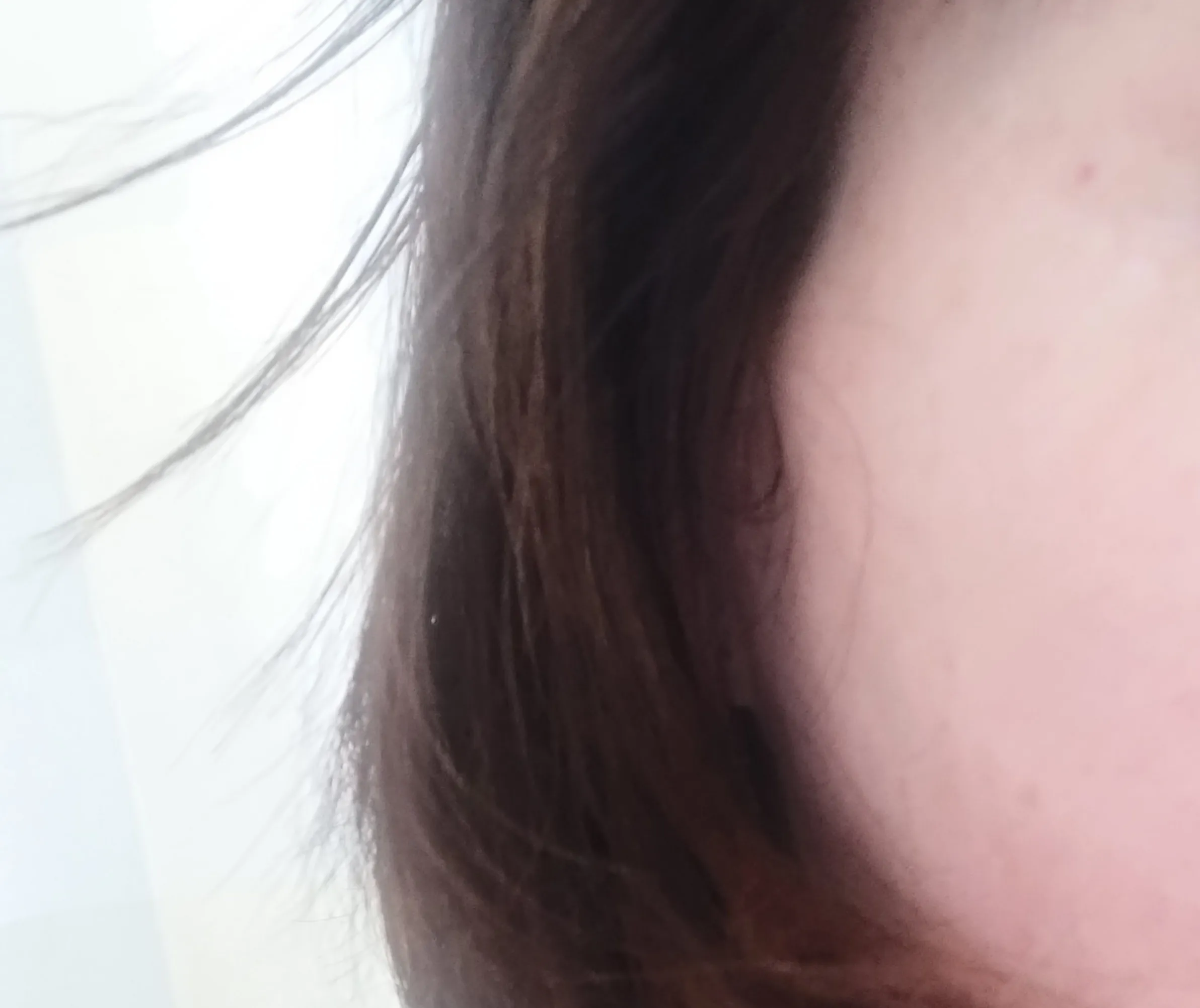 Before treatment — Skin Regeneration #Skin Elasticity #For Fine Lines: Rejuran Healer
