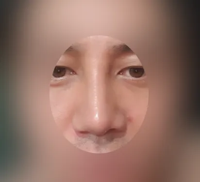 시술 후 — 잘생김에 기준! 남자 코성형