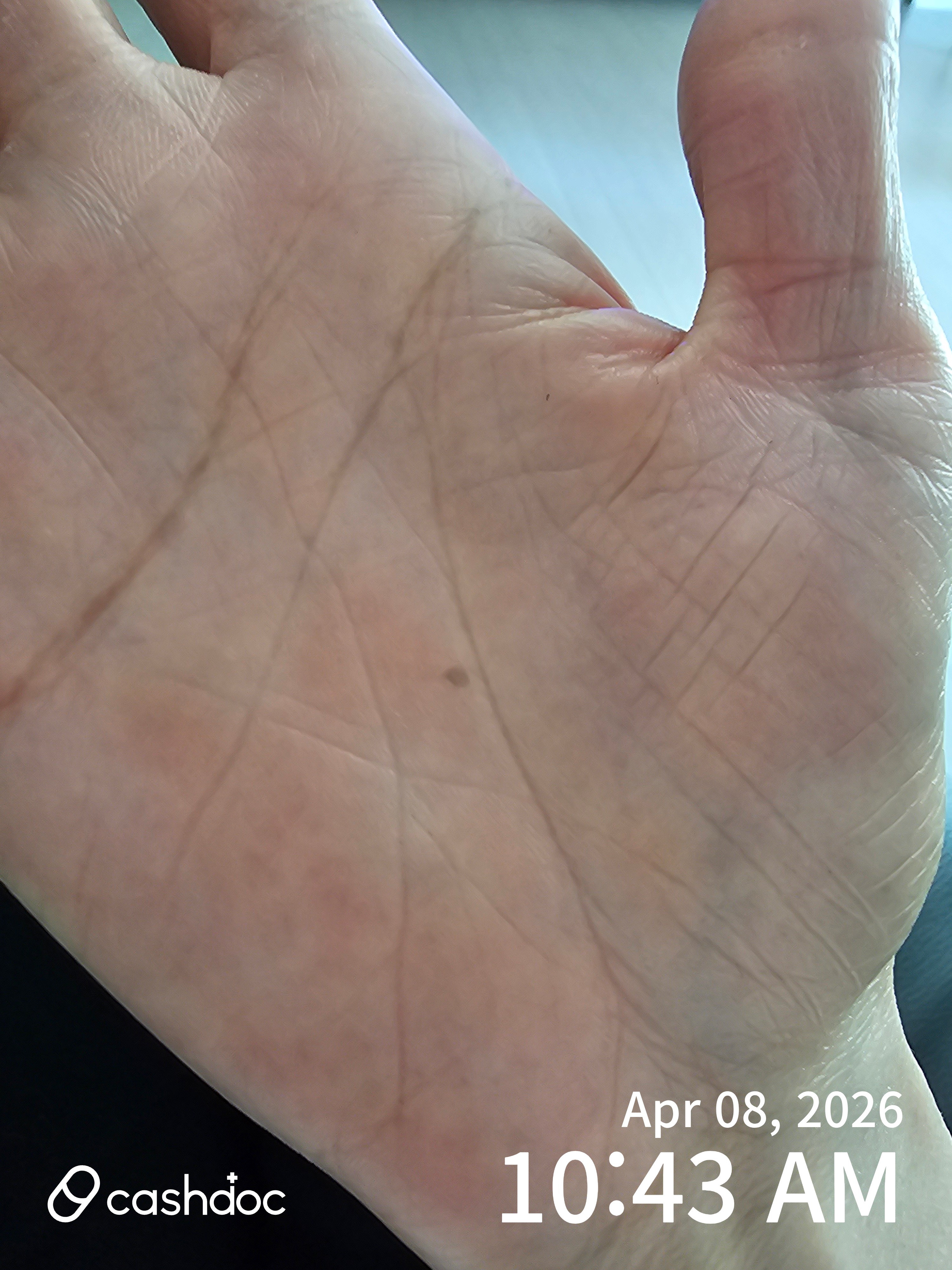 전주시 수경피부과의원에서 주부습진 치료, 차차 좋아져요