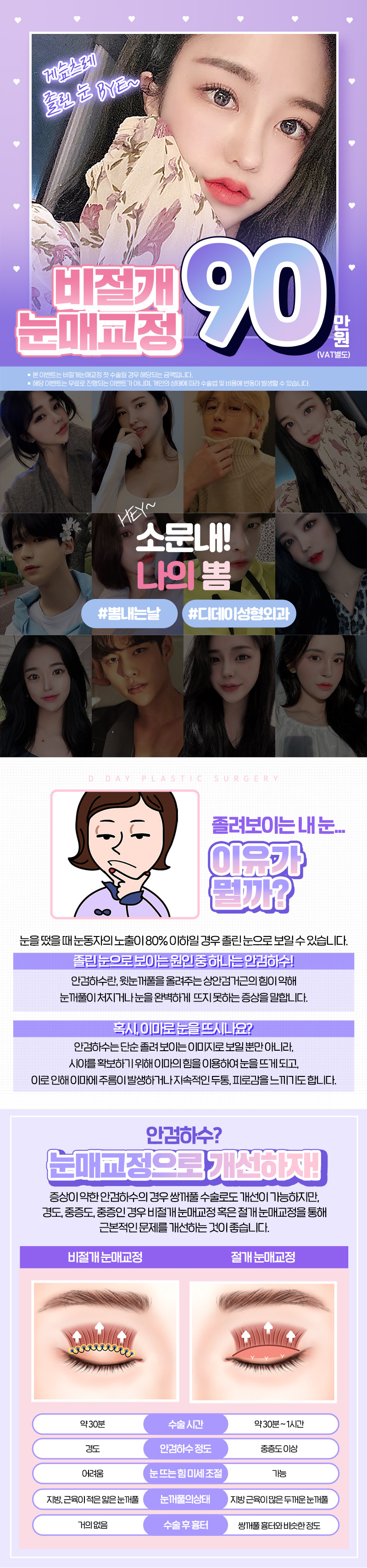 디데이성형외과의원 디데이💖비절개눈매교정 이벤트, 시술 상세 이미지