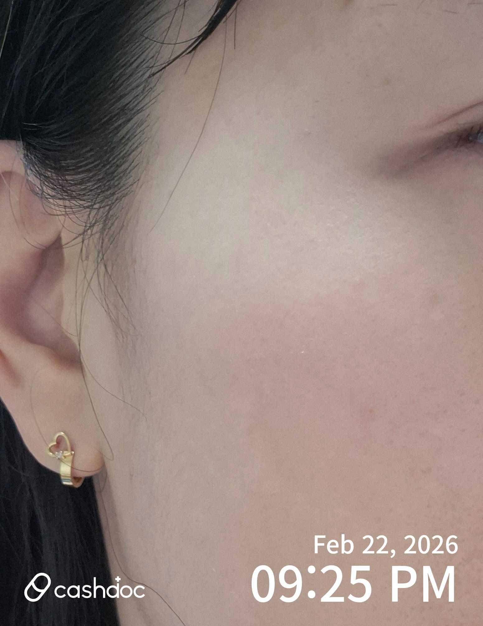 충주 밴스의원에서 만족스러운 리쥬란 시술 경험