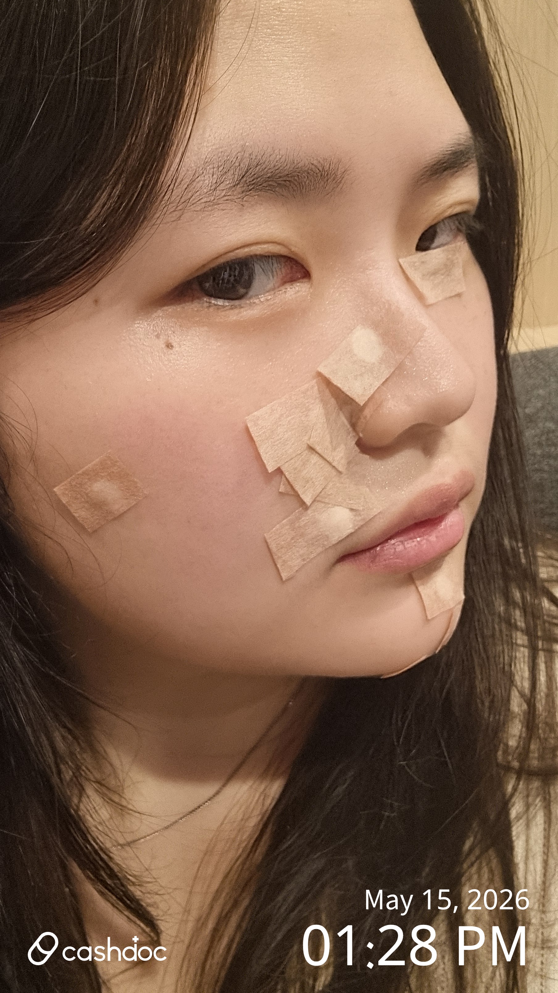 ラルテ議員の授乳域で非粒腫を除去した後、肌がきれいになります。