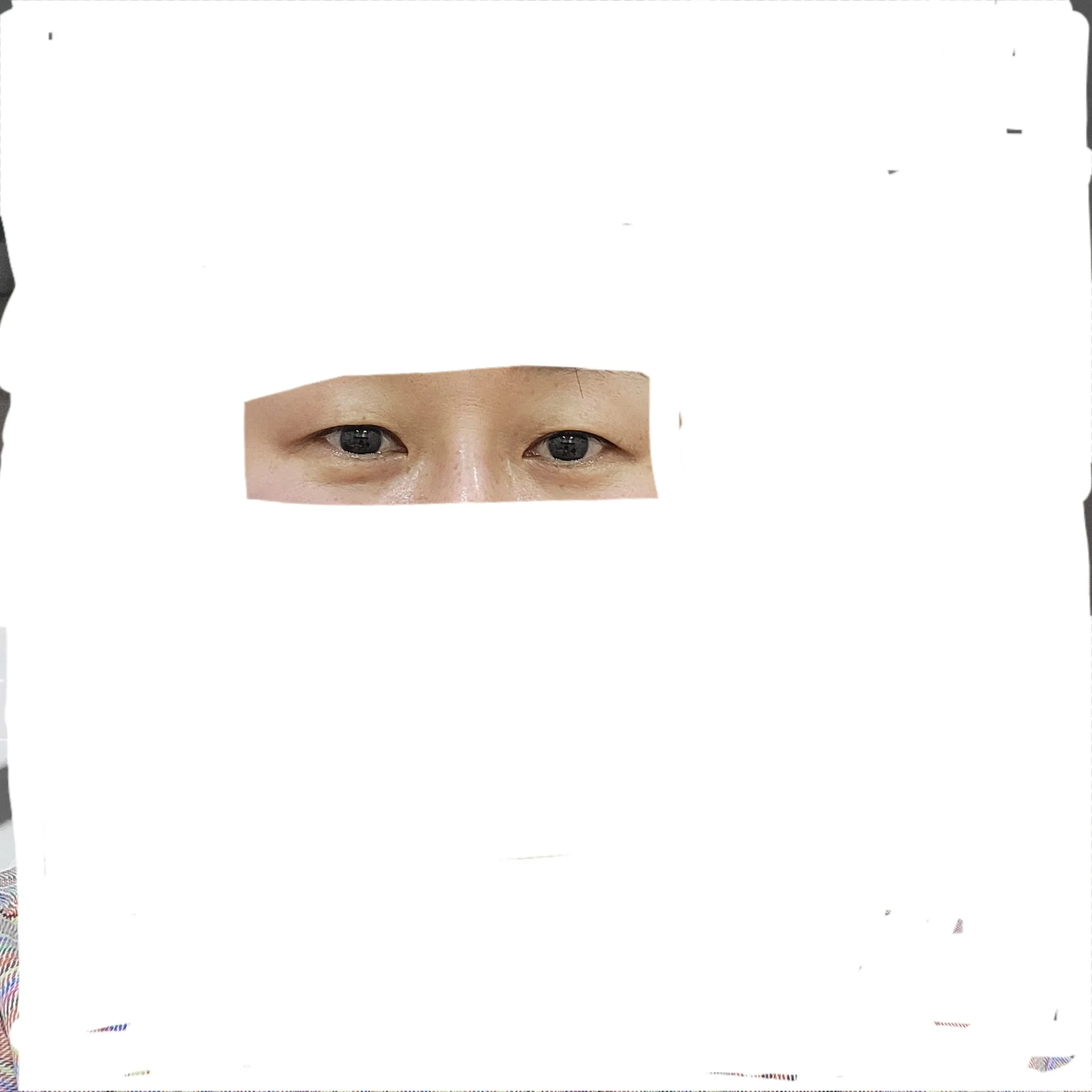 시술 전 — 디데이💖비절개눈매교정