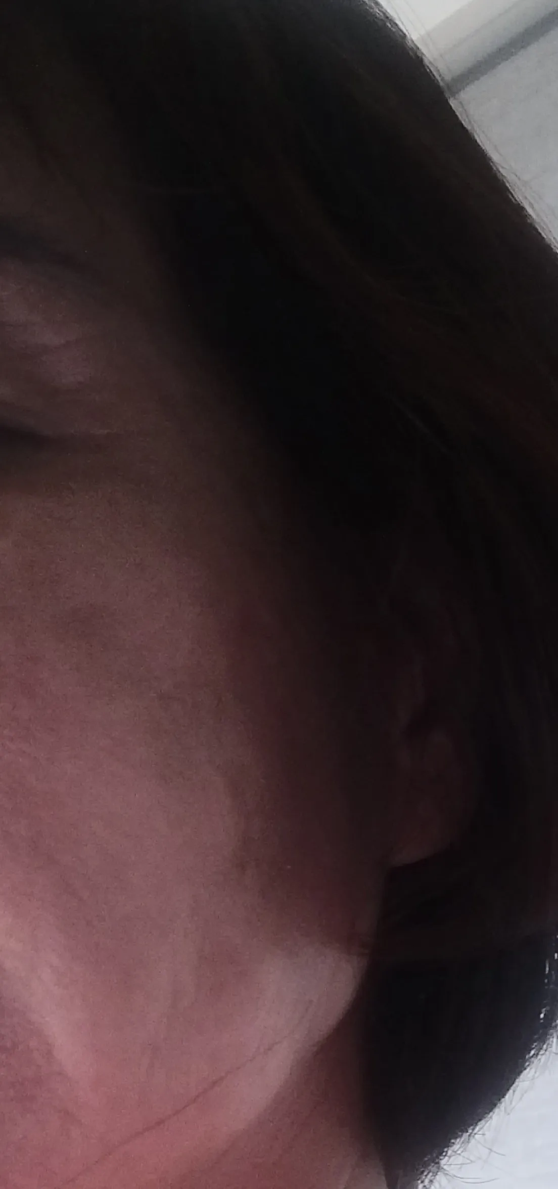 시술 전 — 미케이 기미&주근깨 개선_레이저토닝