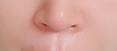 시술 후 — 팔자필러 1cc 3.8만원
