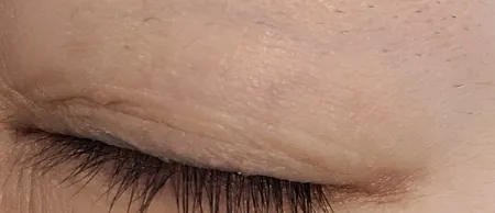 시술 전 — 	번지지않는 아이라인반영구	