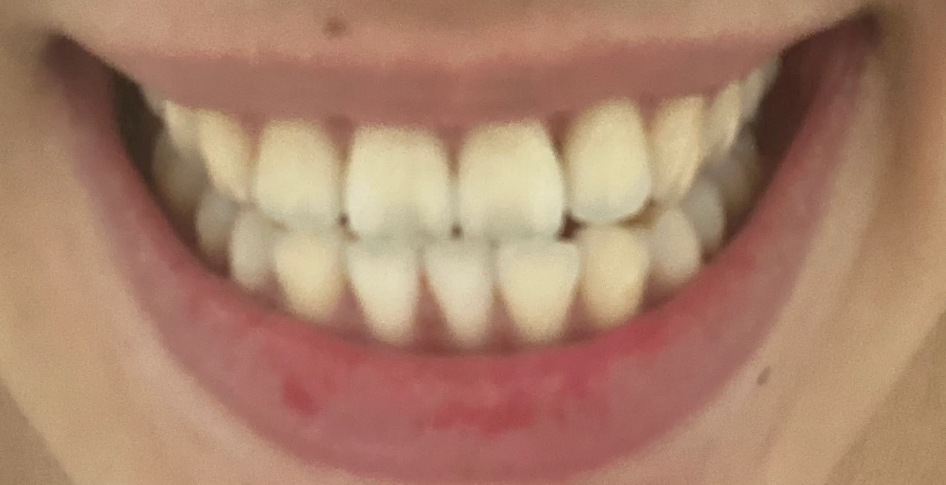 Before treatment — Teeth whitening, really! ♥ 39,000 won ♥