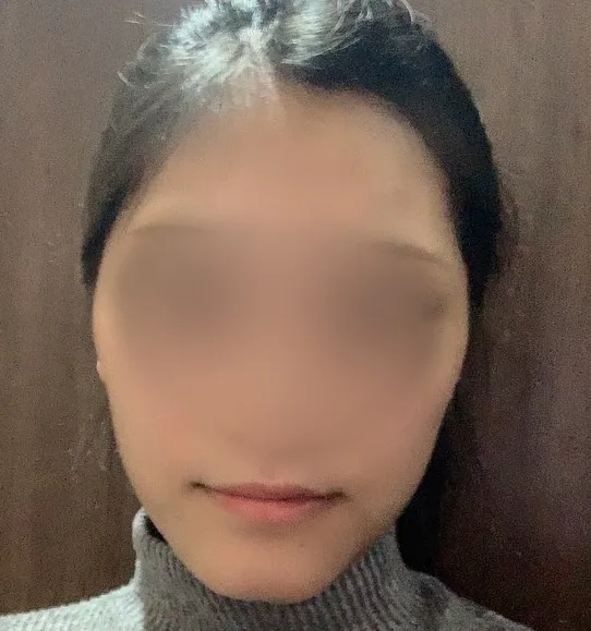 Before treatment — Wonjin_Facial Contouring