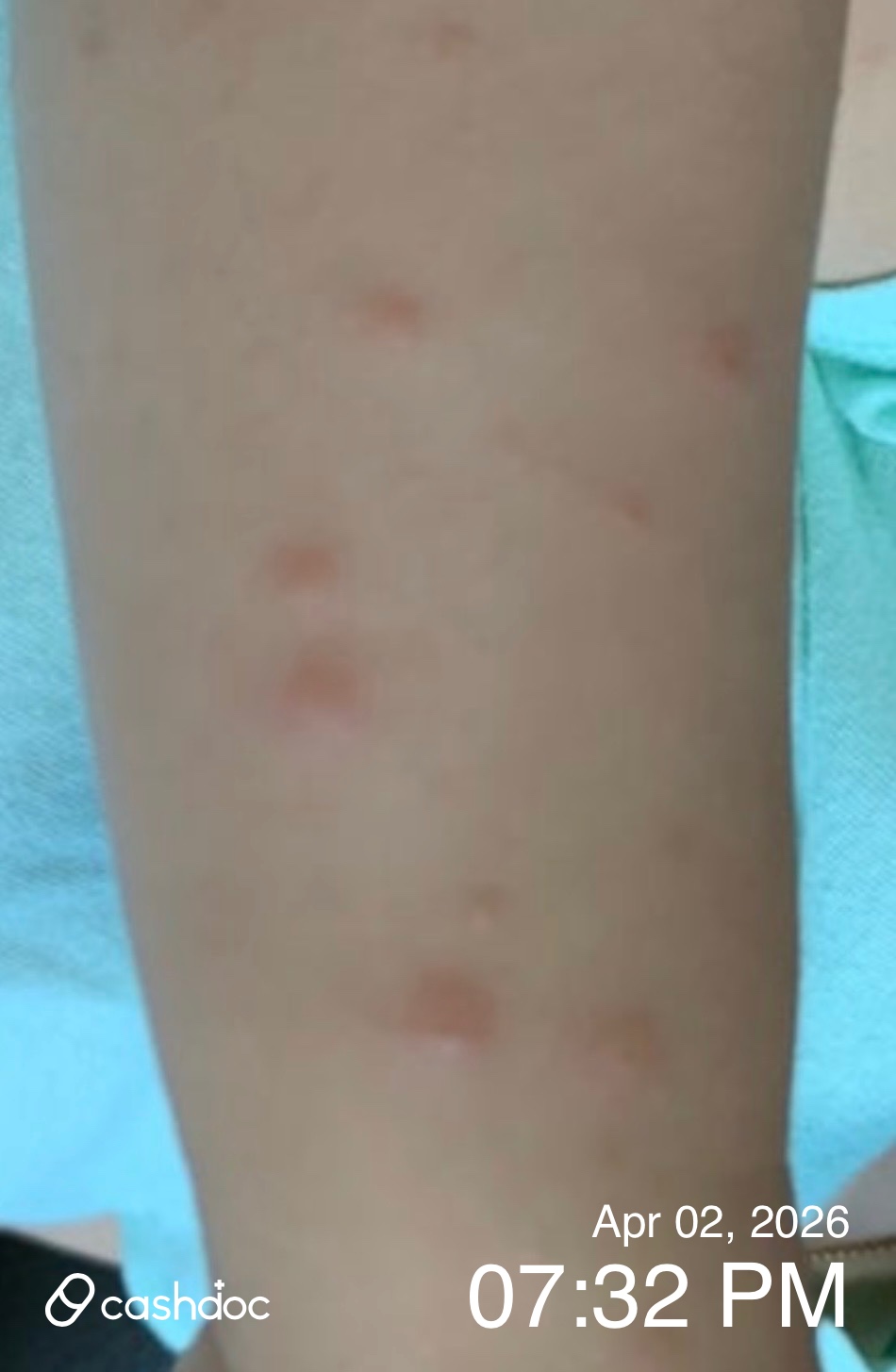 청주시 우리아이소아청소년과, 수족구 자상한 진료 후기