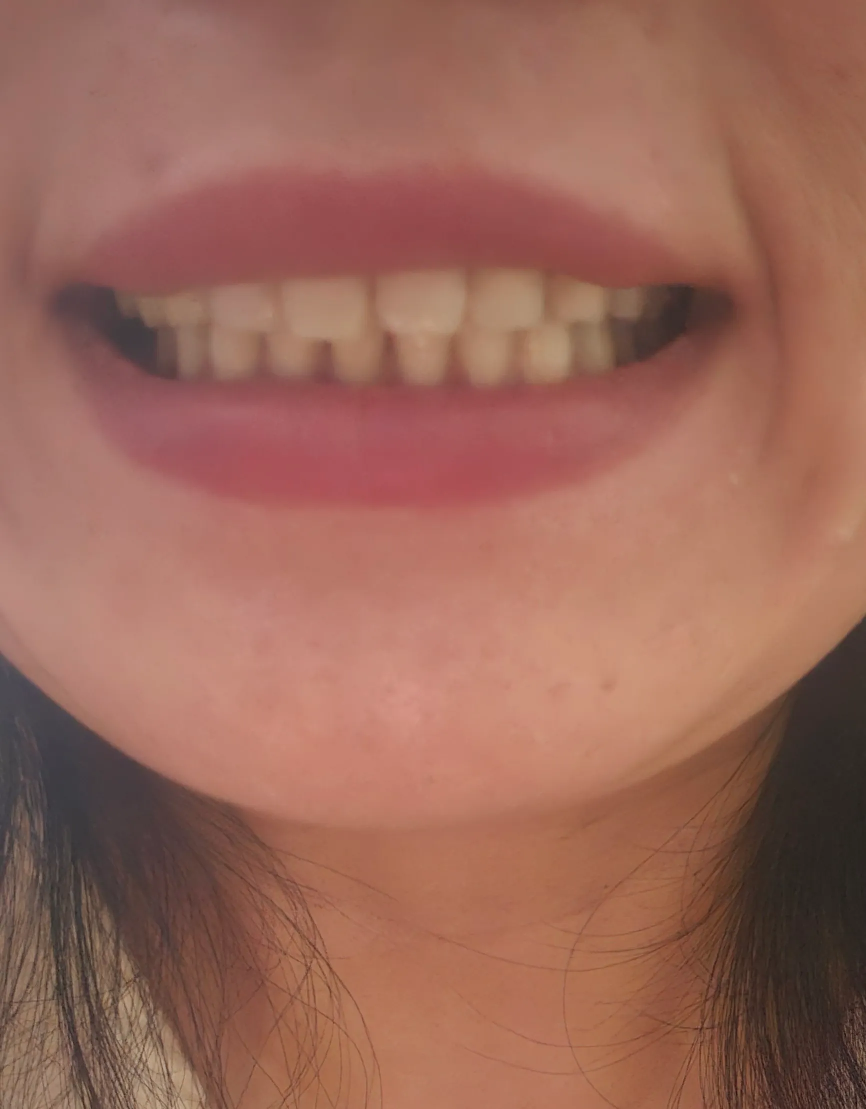 Before treatment — Smart Teeth Whitening