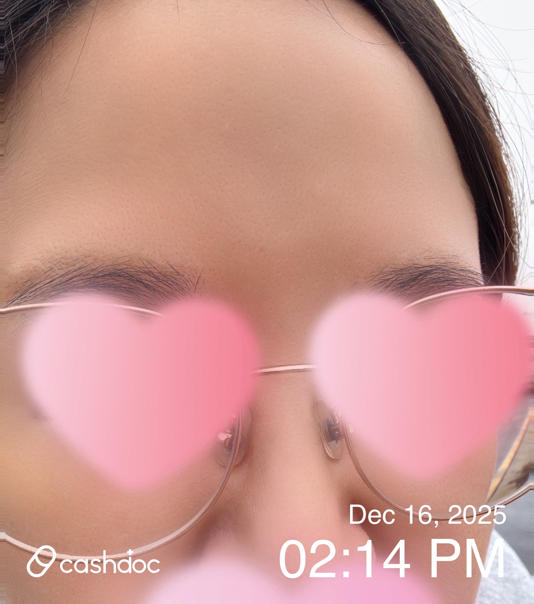 파주시 365다움의원, 보톡스로 주름 개선 경험 후기