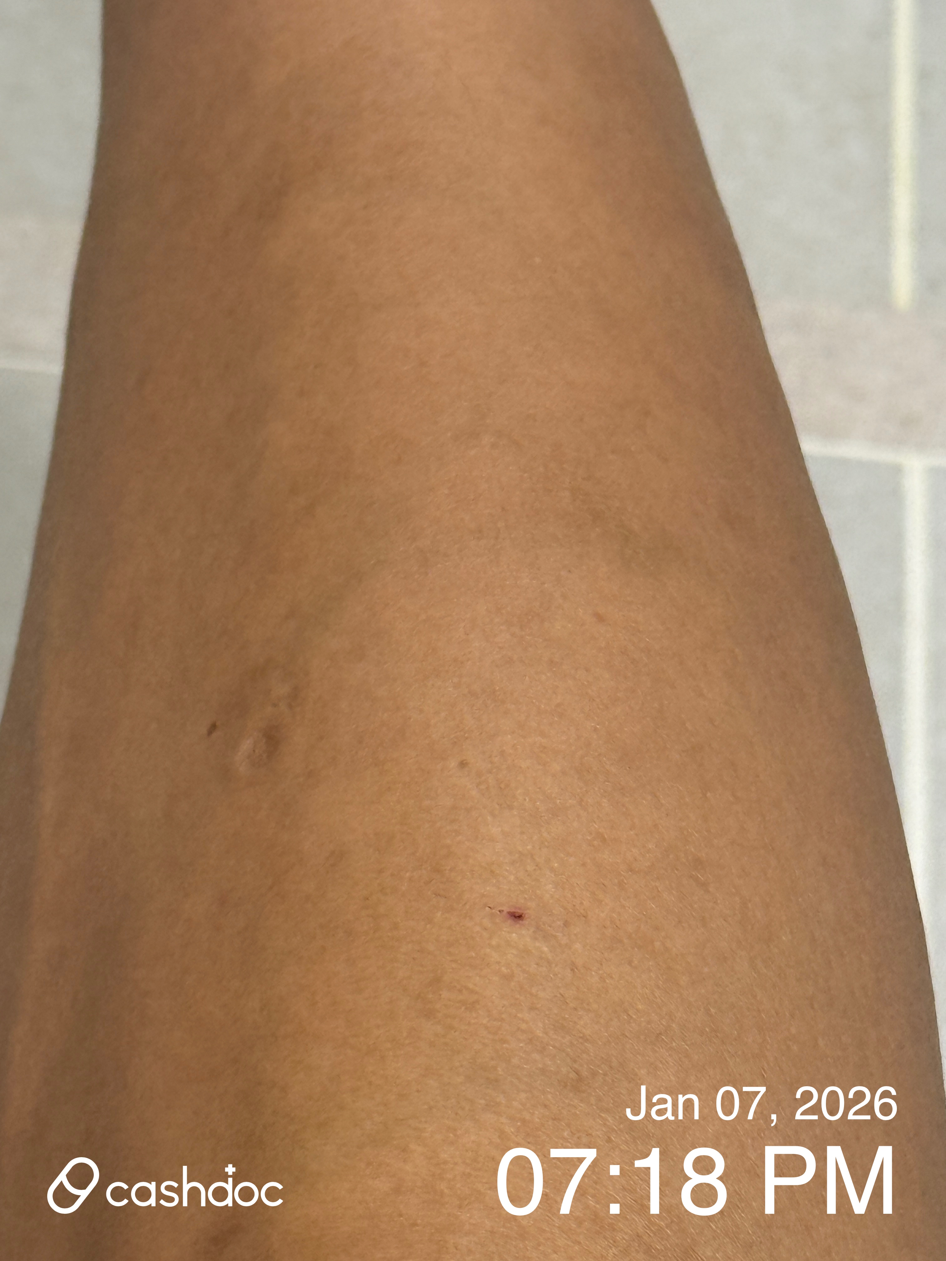 강남구 모리스의원에서 매끄러운 다리 제모 경험!