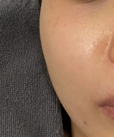 Before treatment — Rejuran, Elasticity and Regeneration in One