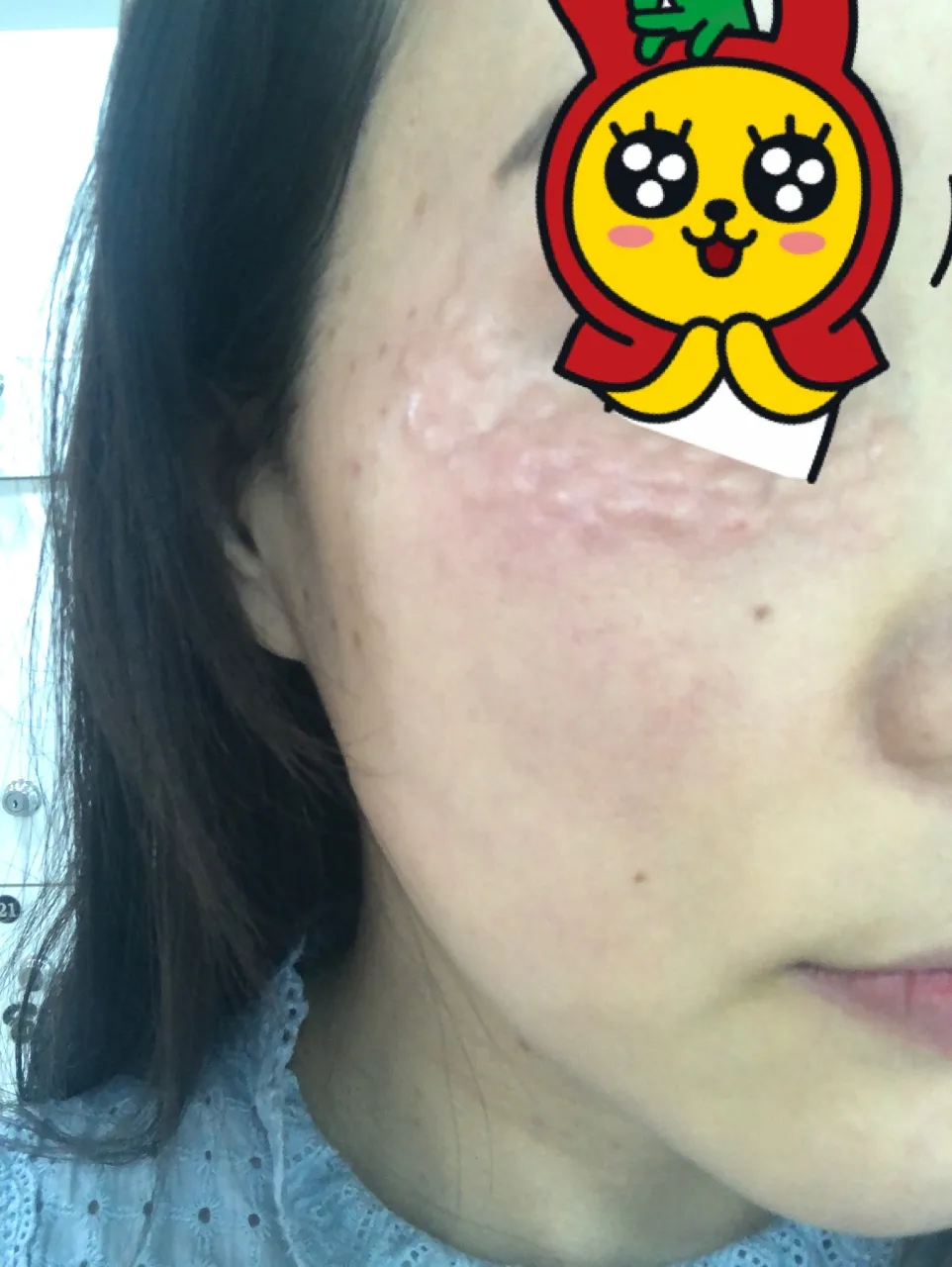 After treatment — Pain-Reducing Special Offer #Rejuran Healer