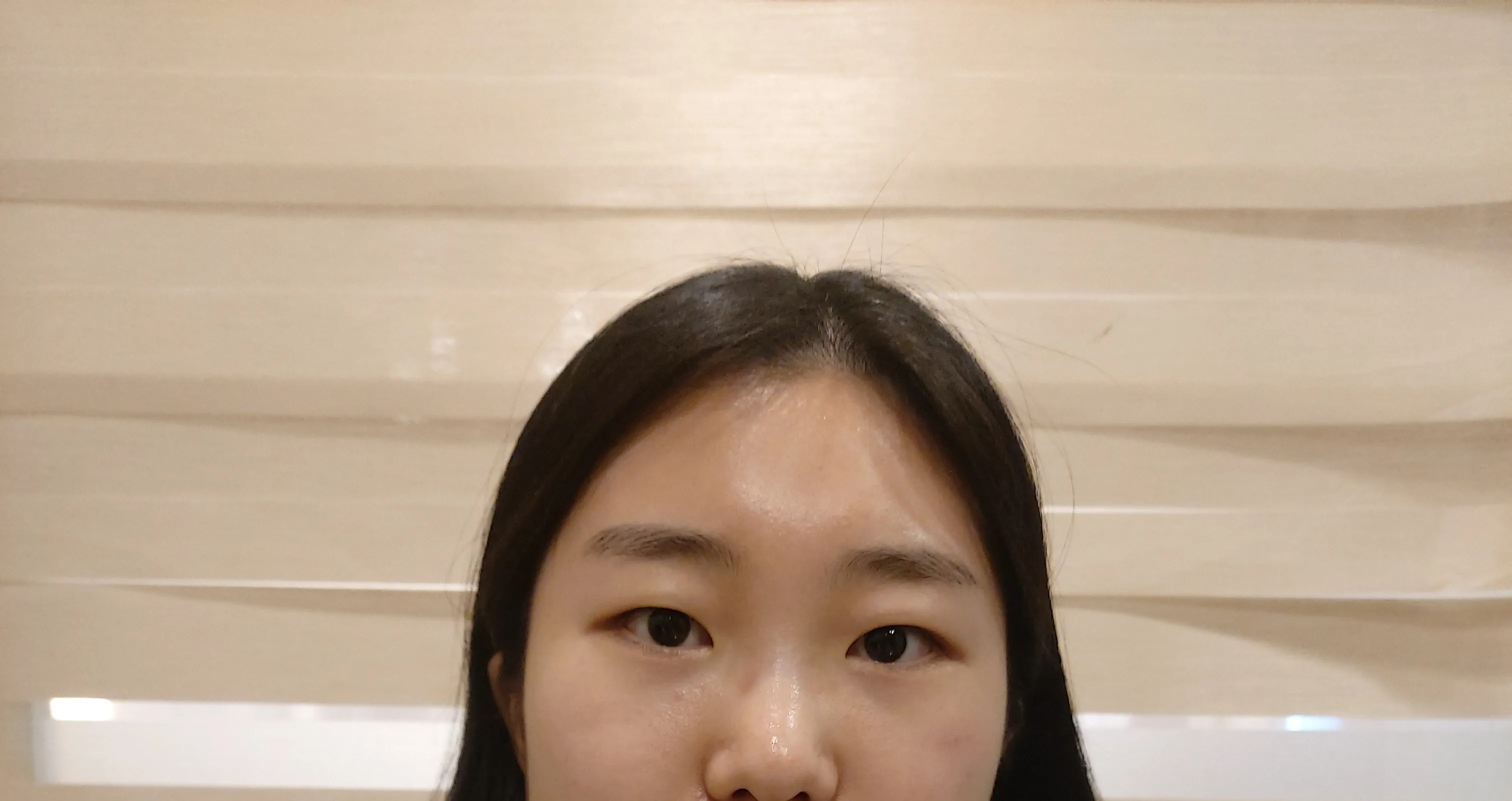 施術前 — 👁‍🗨目頭切開修復👶